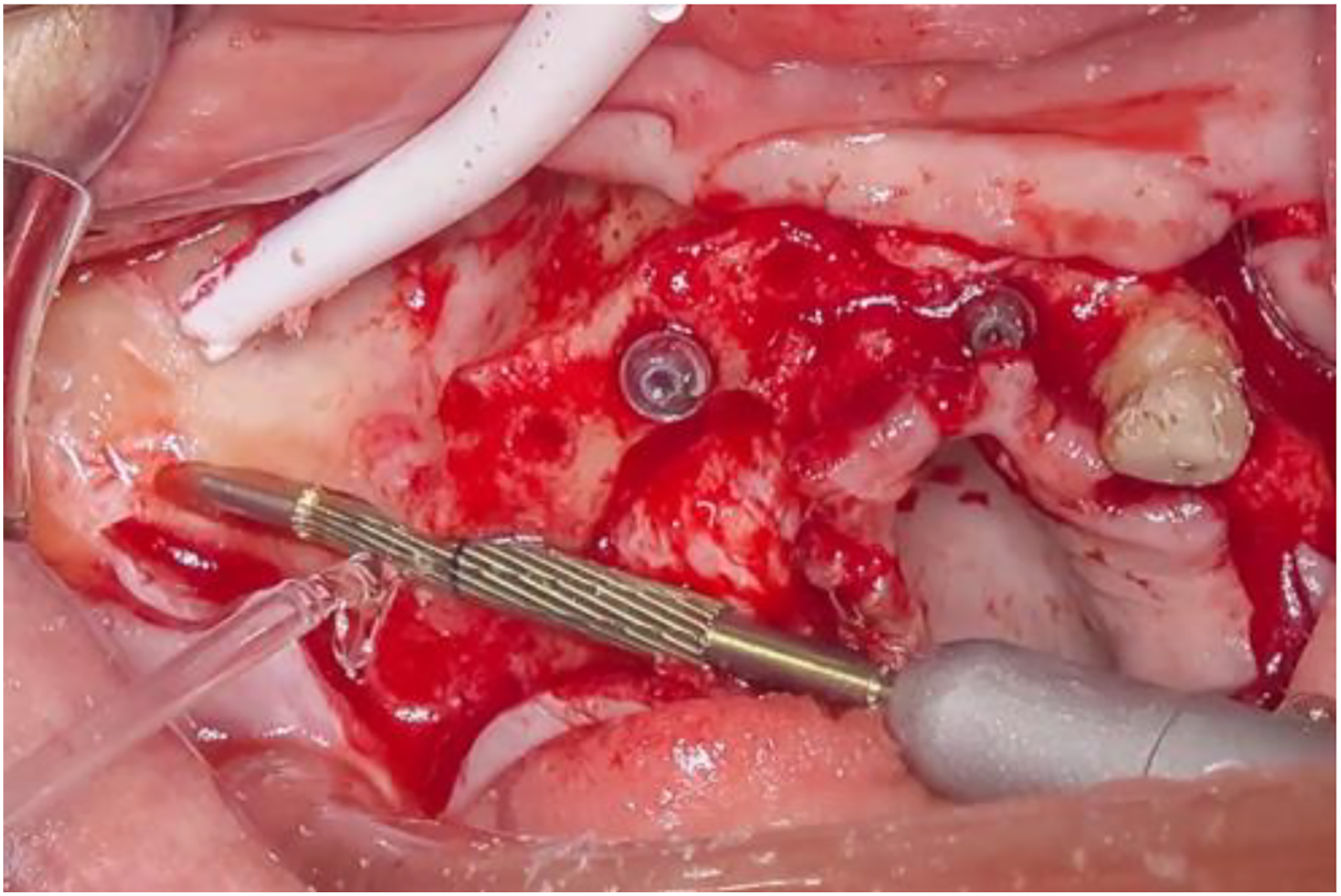 A photo shows an implant collar with screws, a surgical tool, and exposed tissue.