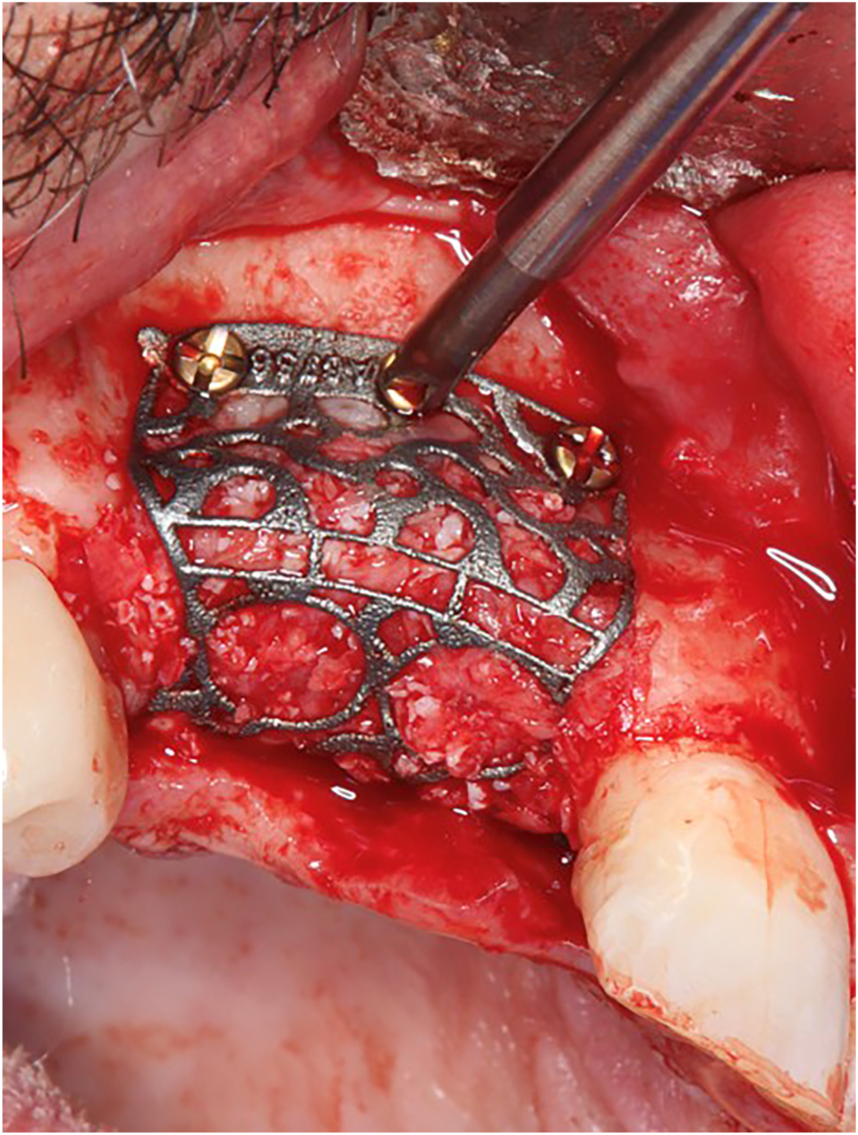 A photograph of an intraoperative surgical field with a metallic lattice mesh structure positioned in the anterior maxillary region, secured with surgical instruments and sutures.