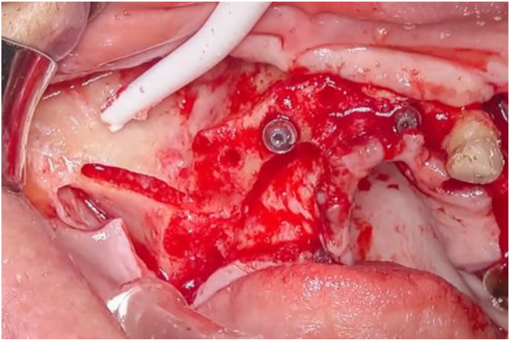 A photo shows a slot with bone grafting and screws in exposed tissue.