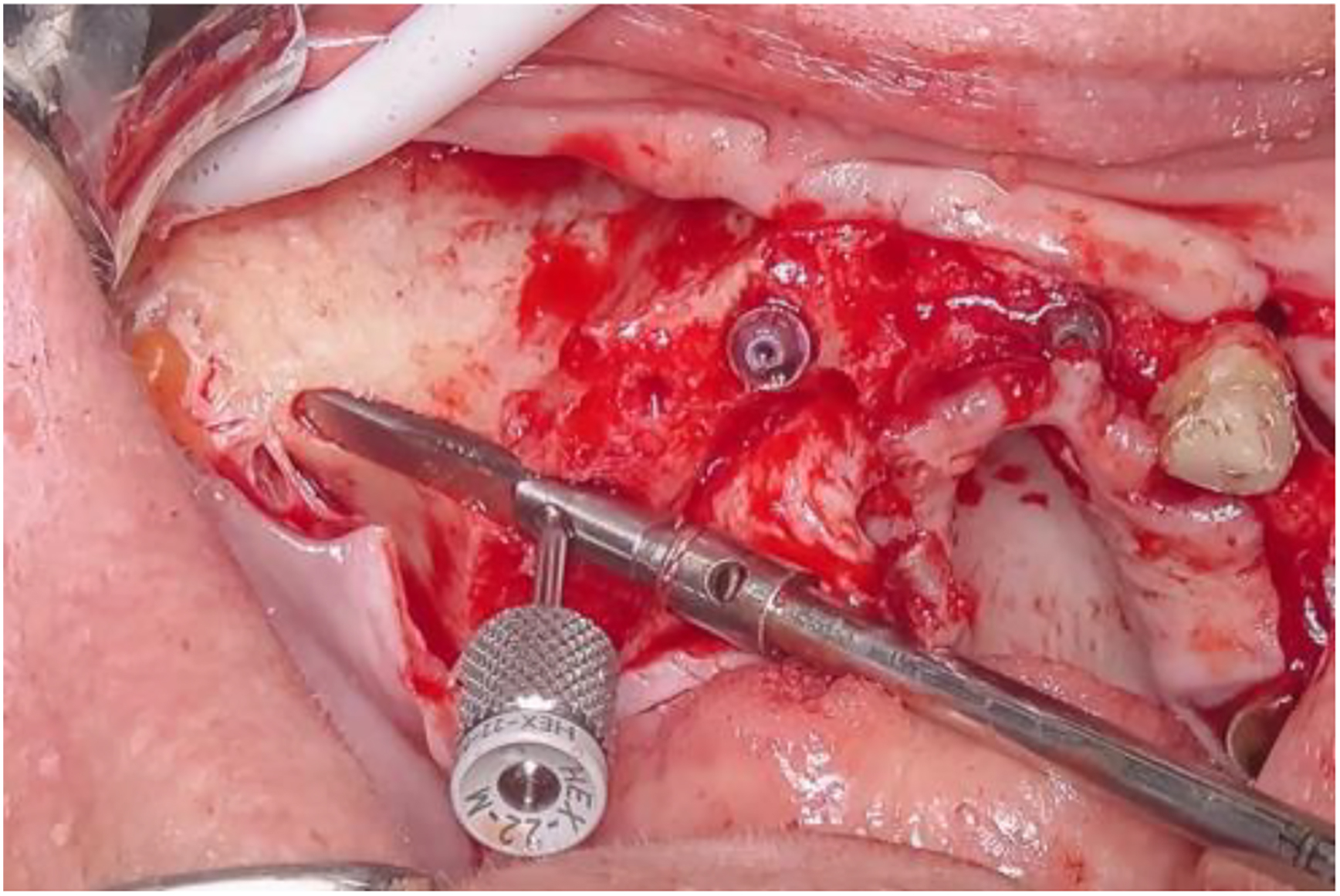 A photo shows a dental implant with a driver attached to a mount screw in a model of teeth.