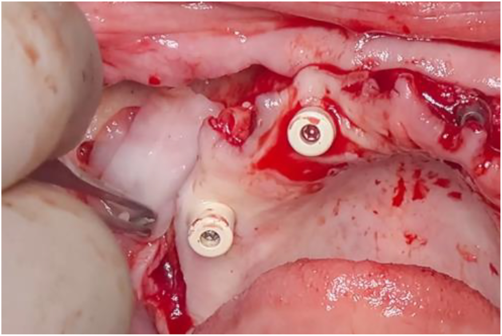 A photo shows P R F membranes on the buccal aspect with screws in exposed tissue, a surgical tool, and an instrument.