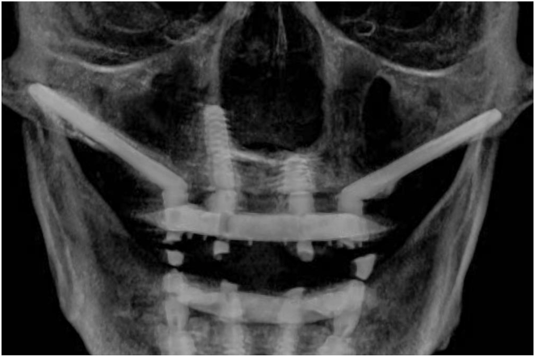 A radiographic image shows anterior piriform and nasal floor cortical anchorage with Straumann B L X and Zygoma Slot implants in a skull.