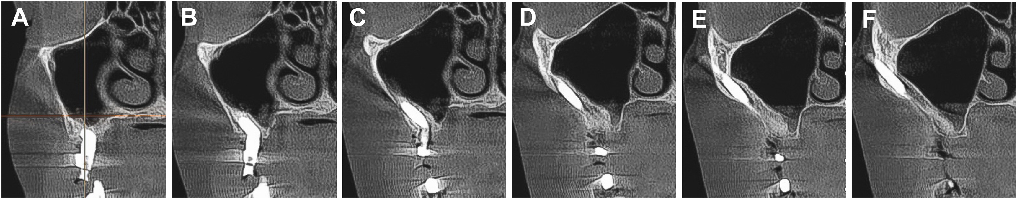 A radiographic image shows six cross-sections of a slot technique with clear sinuses and a thin bone layer along an implant.