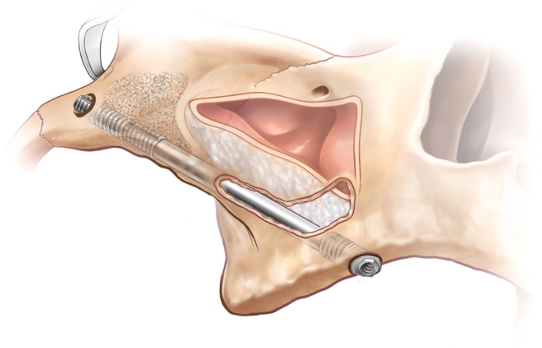 Cutaway skull illustration shows curved implant trajectory beneath sinus cavity, bony channel guiding implant path, maintained sinus floor above implant body, and implant direction shaped by bone contour.