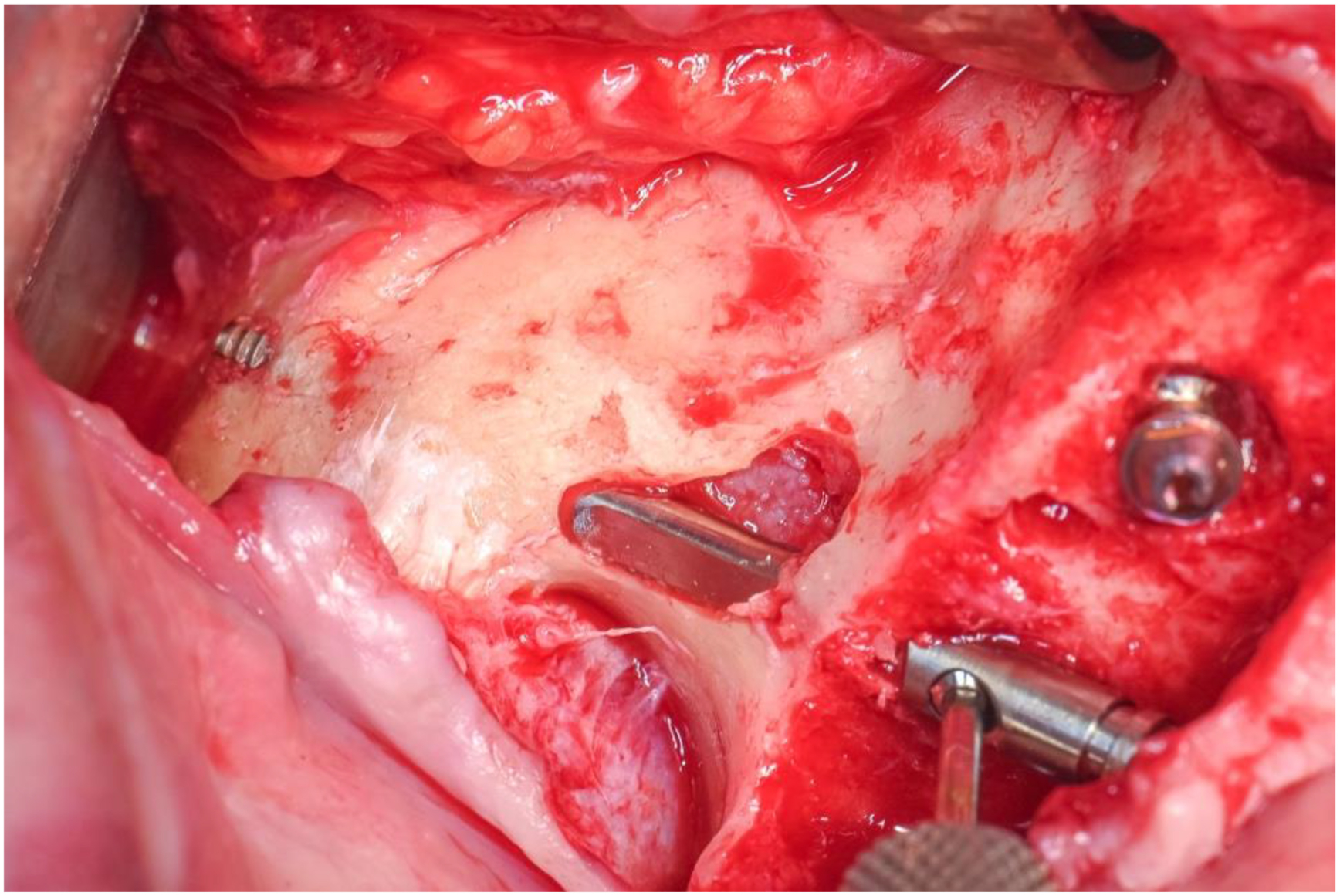 A photo shows a Straumann Z A G A Flat implant with a surgical tool and screws in exposed tissue.