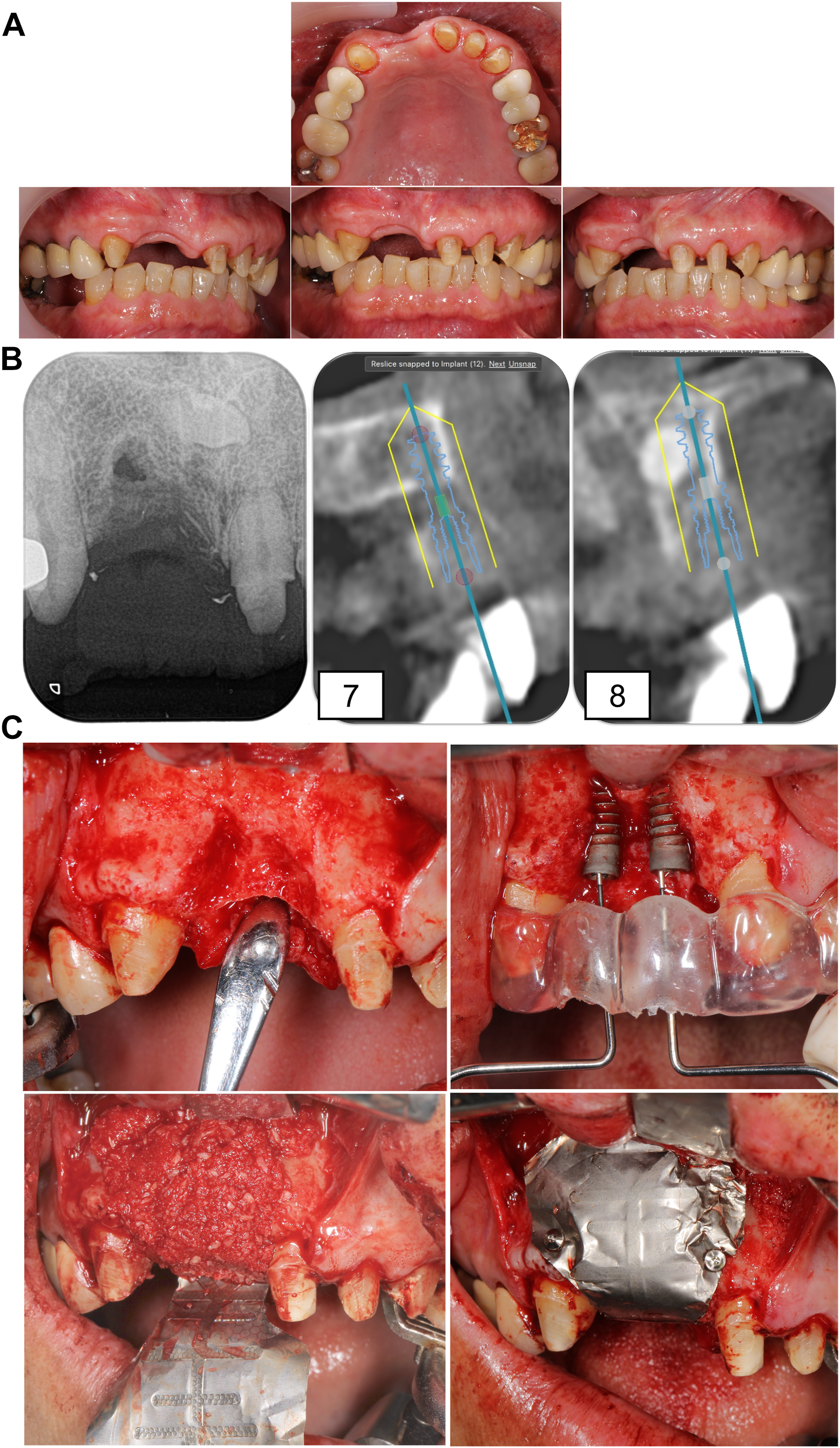 A multi-panel dental photo, radiographs, and C T show the severe loss of two front teeth and jawbone, followed by a major bone grafting and dental implant surgery to restore the area.