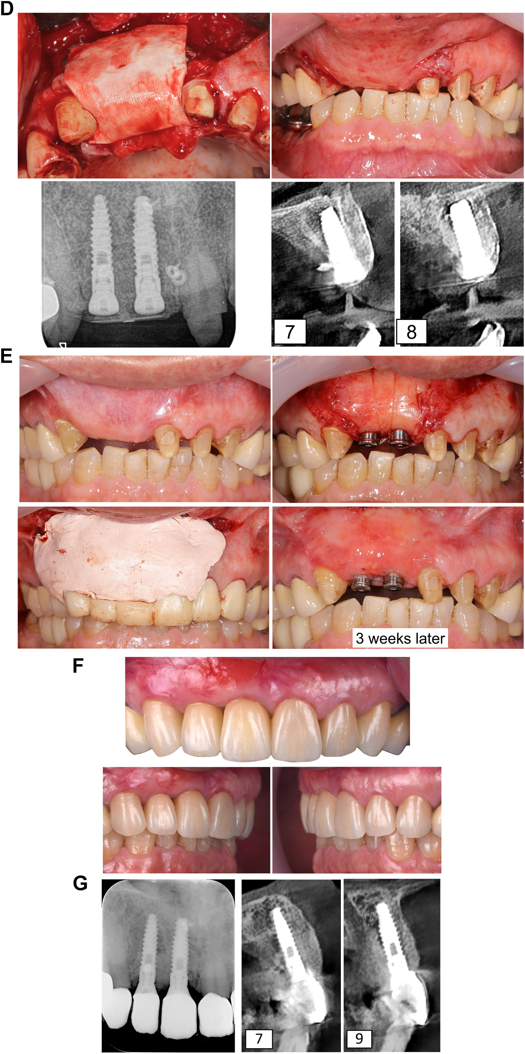 A multi-panel dental photo, radiographs, and C T show the severe loss of two front teeth and jawbone, followed by a major bone grafting and dental implant surgery to restore the area.