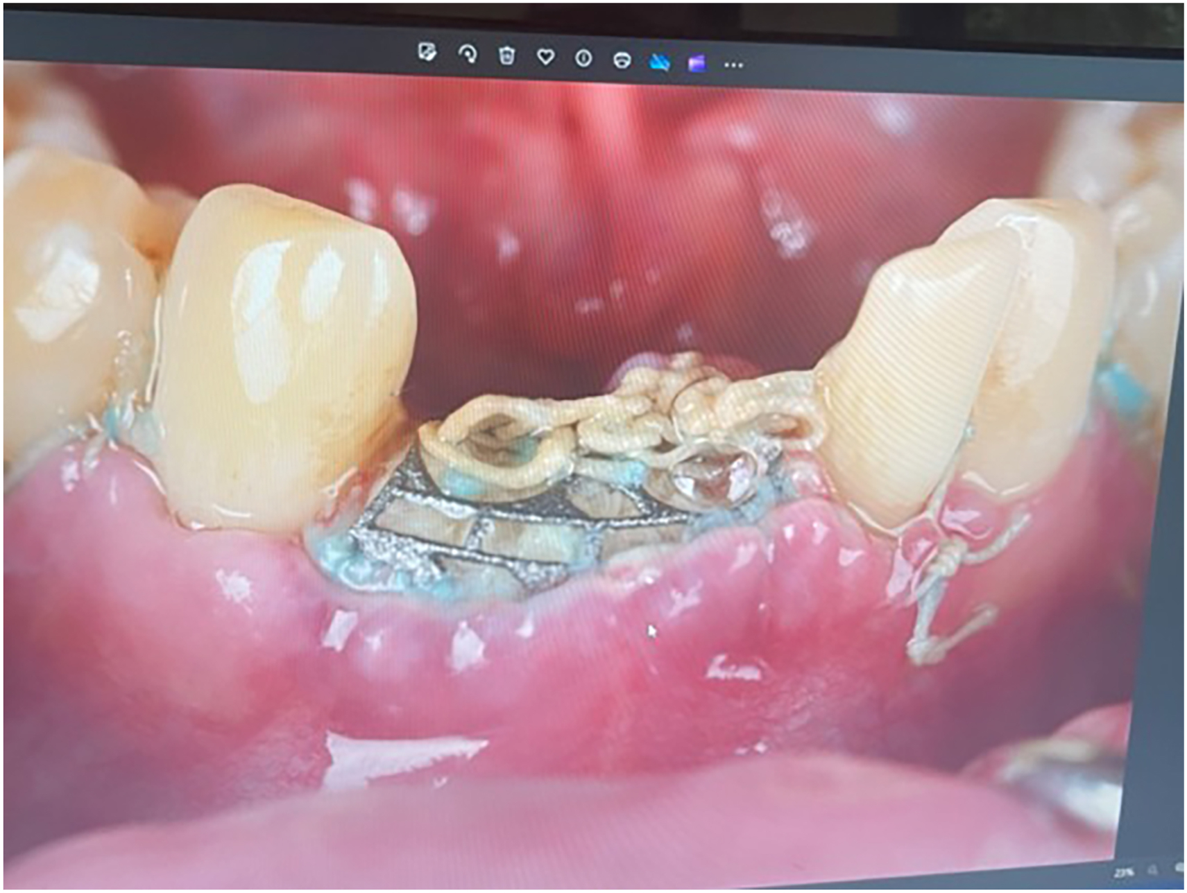 A photograph of a customized metallic mesh secured with sutures to the anterior mandibular region for vertical bone augmentation, with adjacent natural teeth and graft material.