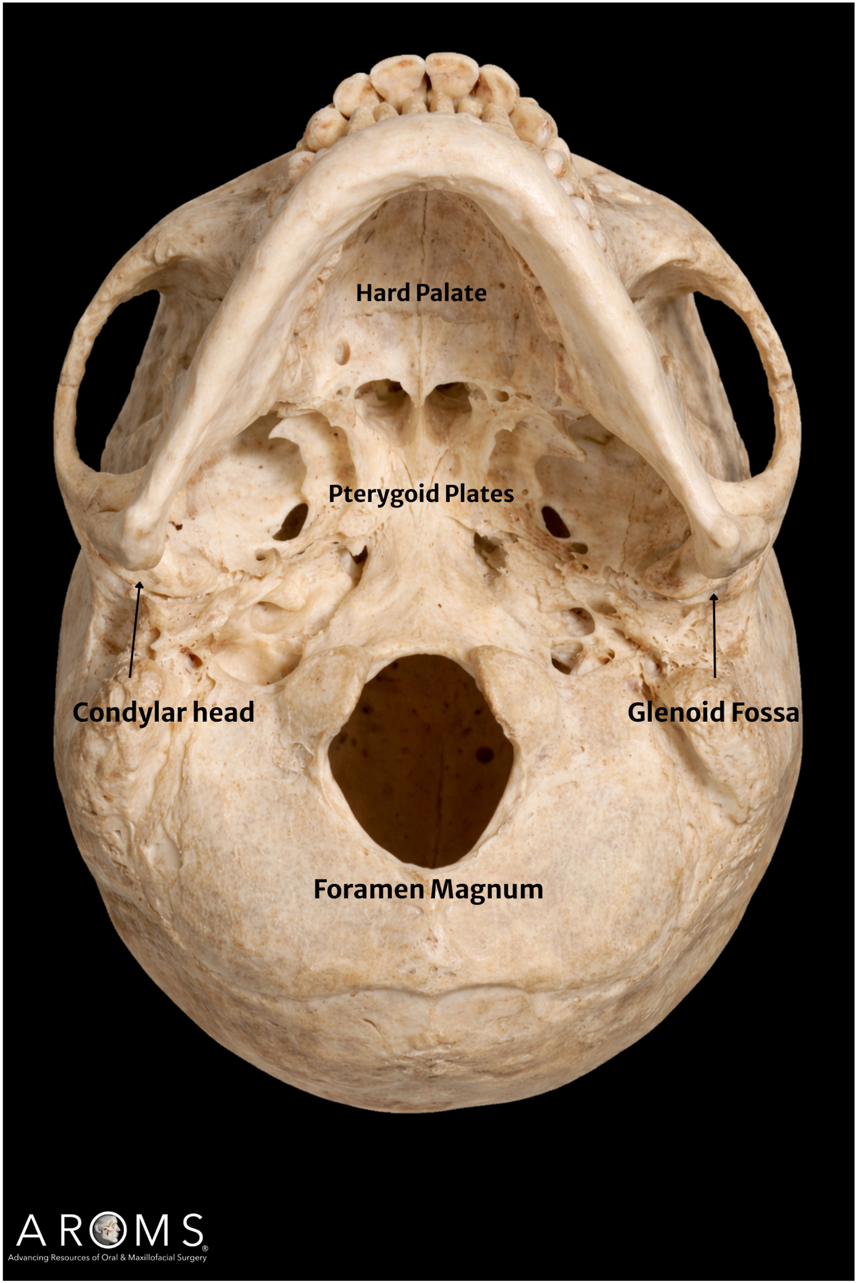 Alt text begins. A photograph of a skull in axial view highlighting temporomandibular joint osseous anatomy with labeled hard palate, pterygoid plates, condylar head, glenoid fossa, and foramen magnum. Alt text provided by Elsevier.