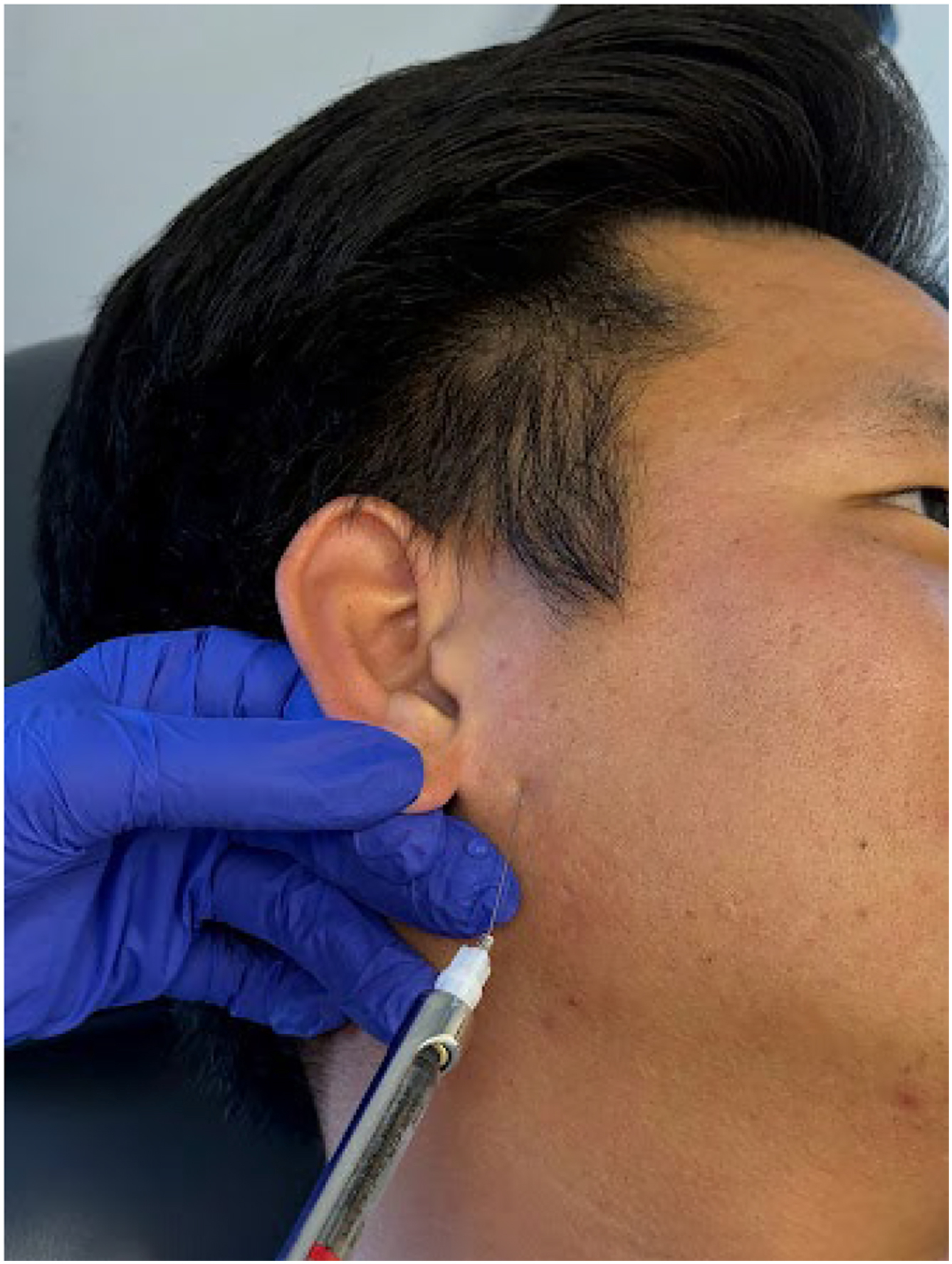 Alt text begins. A photograph depicts gloved hands performing local infiltration on a patient with a syringe inserted into the skin below the ear along the lateral mandibular region. Alt text provided by Elsevier.