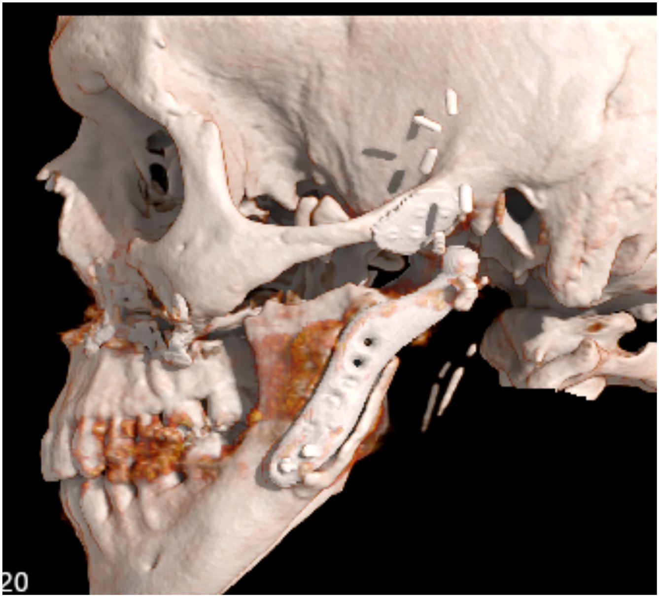 Alt text begins. A three-dimensional computed tomography reconstruction of a skull shows a displaced mandibular prosthesis and loose screws floating freely near the joint area. Alt text provided by Elsevier.