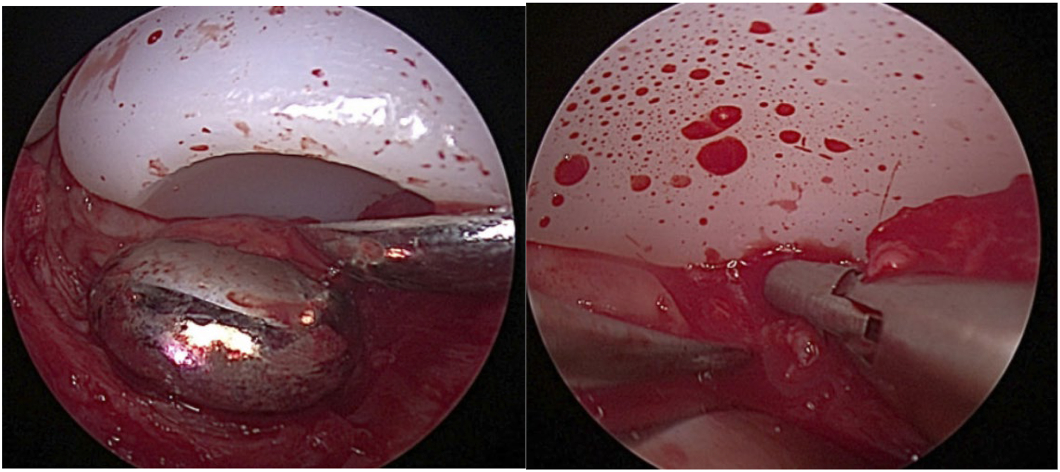 Alt text begins. A two-panel arthroscopic view shows a temporomandibular joint total replacement arthroplasty with synovial entrapment being treated using grasping forceps and cautery. Alt text provided by Elsevier.