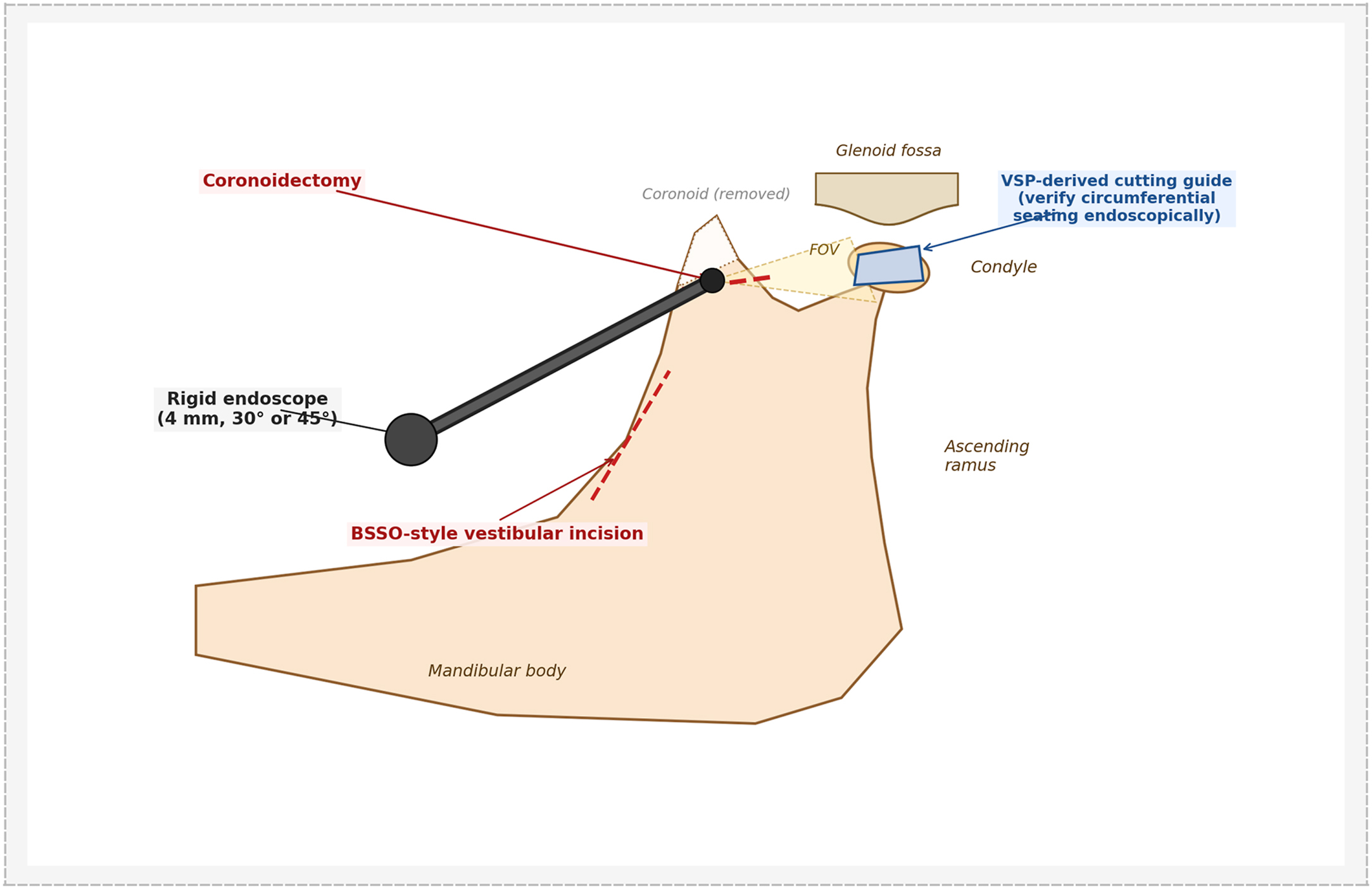 Alt text begins. A diagram shows endoscopic-assisted intraoral access to the condyle through a bilateral sagittal split osteotomy-style vestibular incision and coronoid window. Alt text provided by Elsevier.
