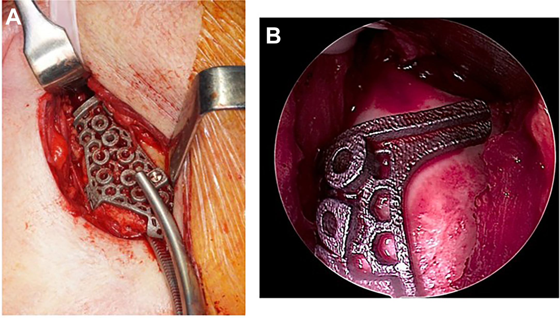 Intraoperative photograph showing a prosthetic joint component positioned within the exposed joint space through a preauricular incision before fixation.