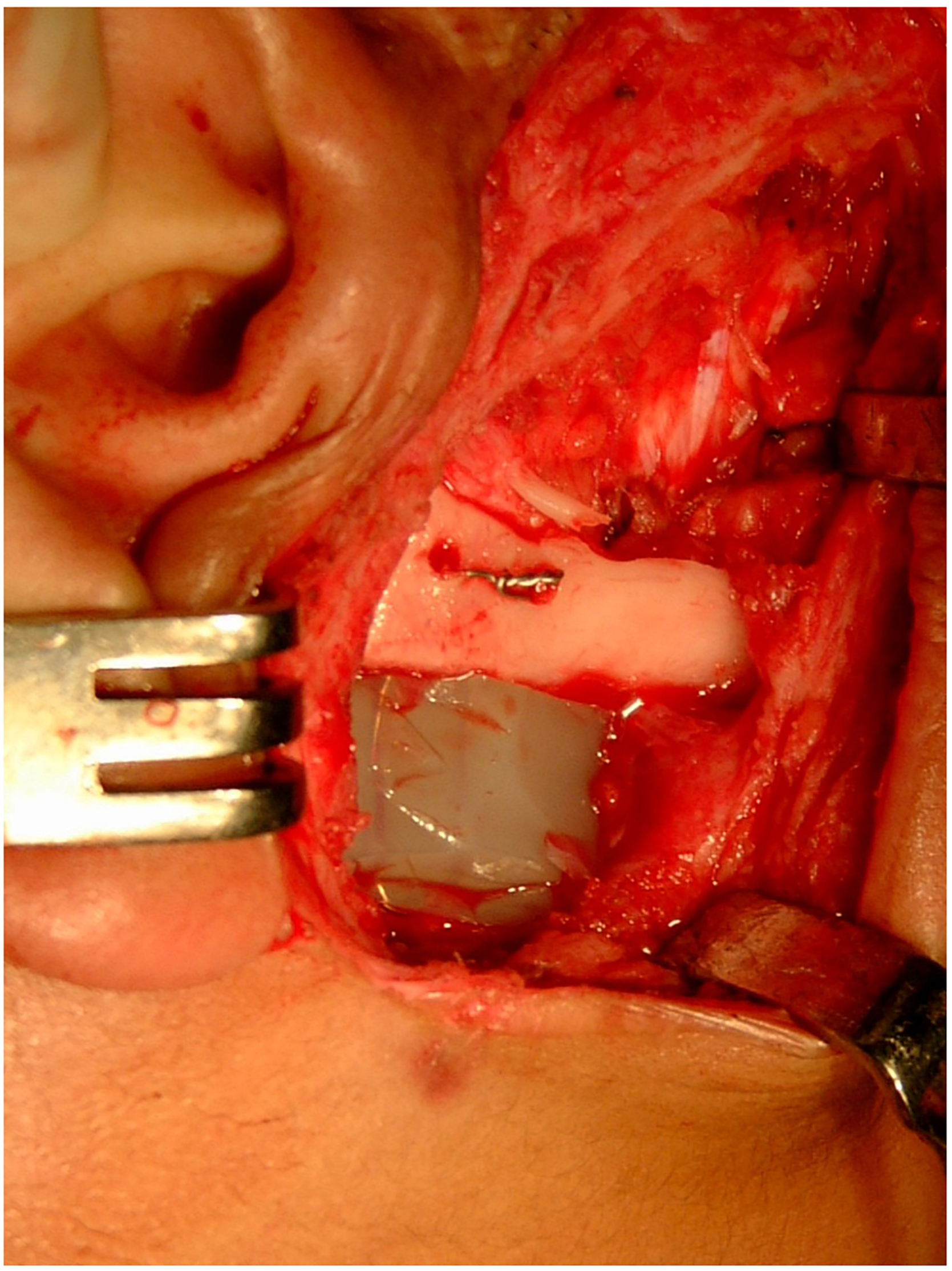 Alt text begins. A two-panel image shows a photograph of a silastic spacer placed in the temporomandibular joint region during surgery and a C T scan shows spacer dislodgement with bilateral reankylosis. Alt text provided by Elsevier.