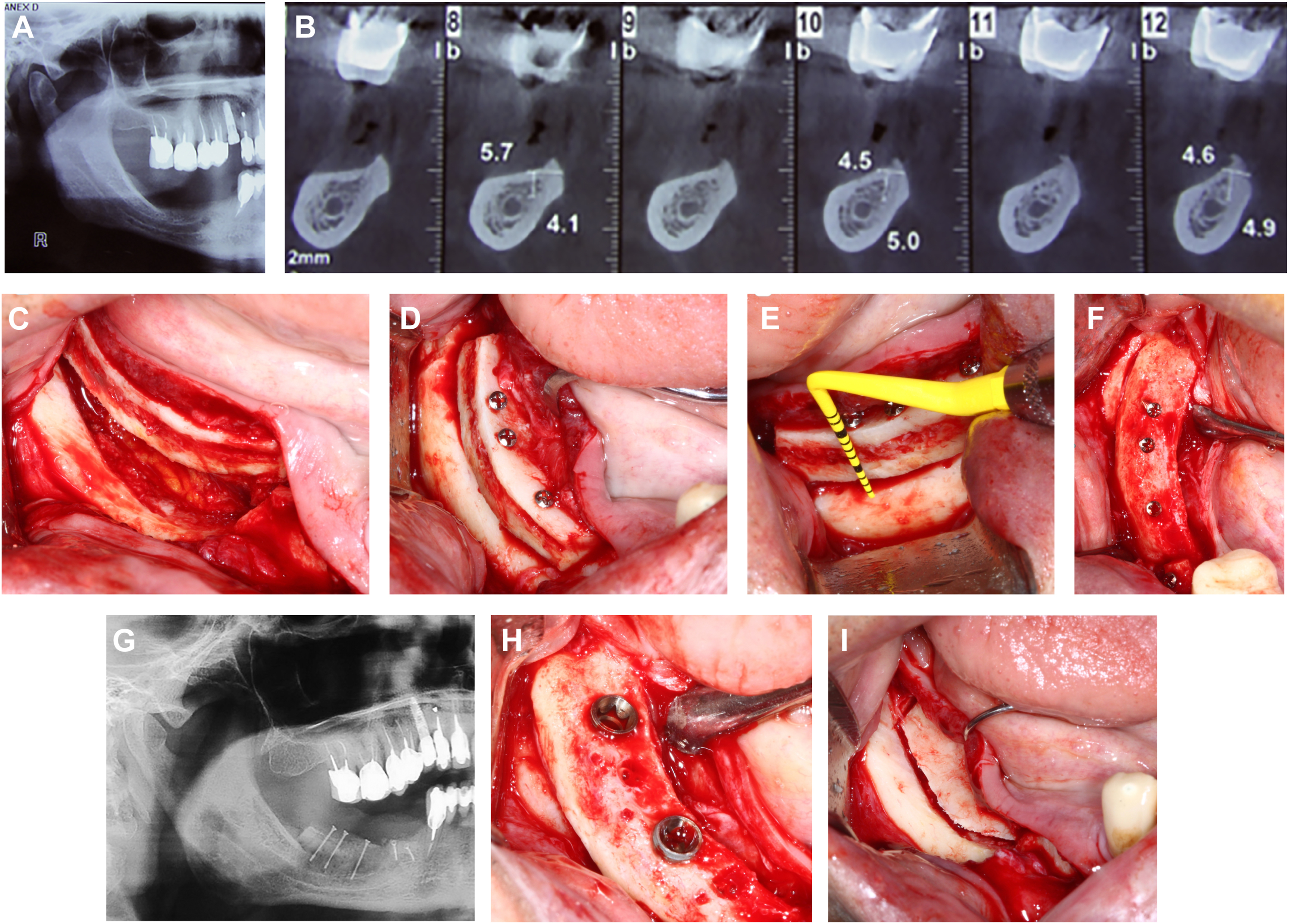 A set of nine panels labeled A to I shows mandibular reconstruction from preoperative radiographs to fixation, grafting, and postoperative healing.