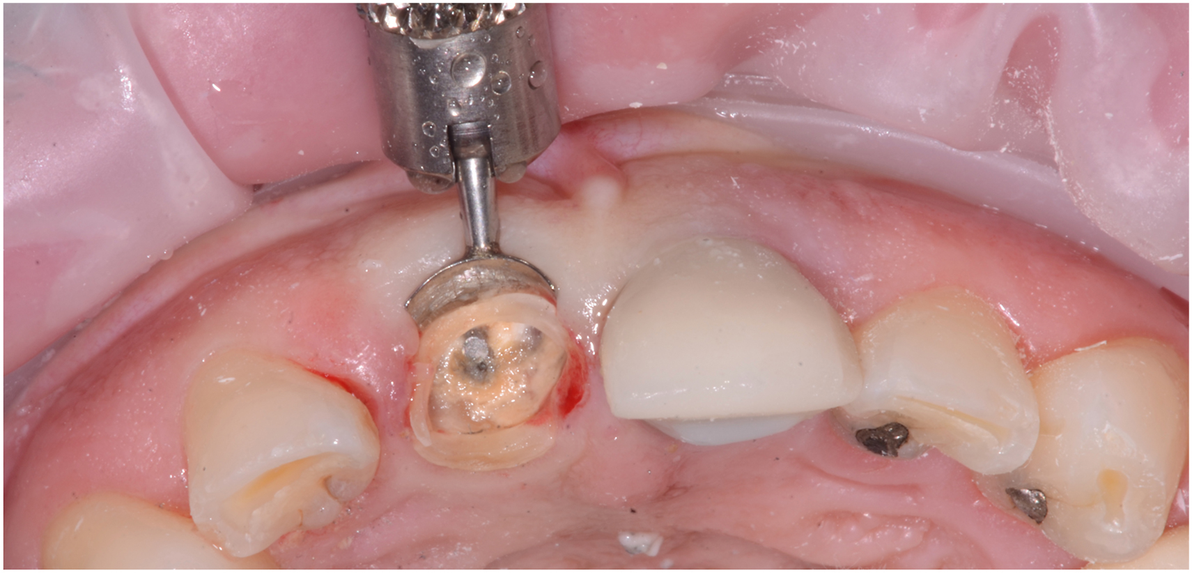 An occlusal view of an upper front tooth during a dental procedure where a dental drill works on a prepared tooth surface near the gum line, surrounded by adjacent teeth with restorations.
