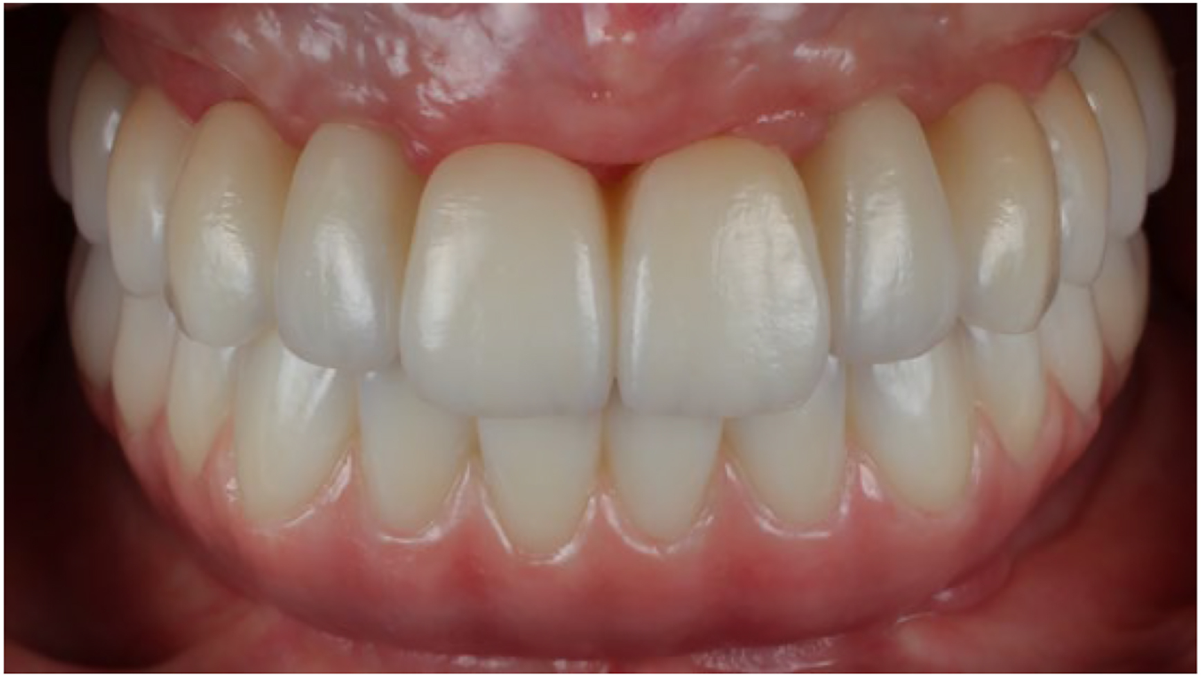 A clinical photo shows a dental prosthesis with teeth and metal attachments in an open mouth.