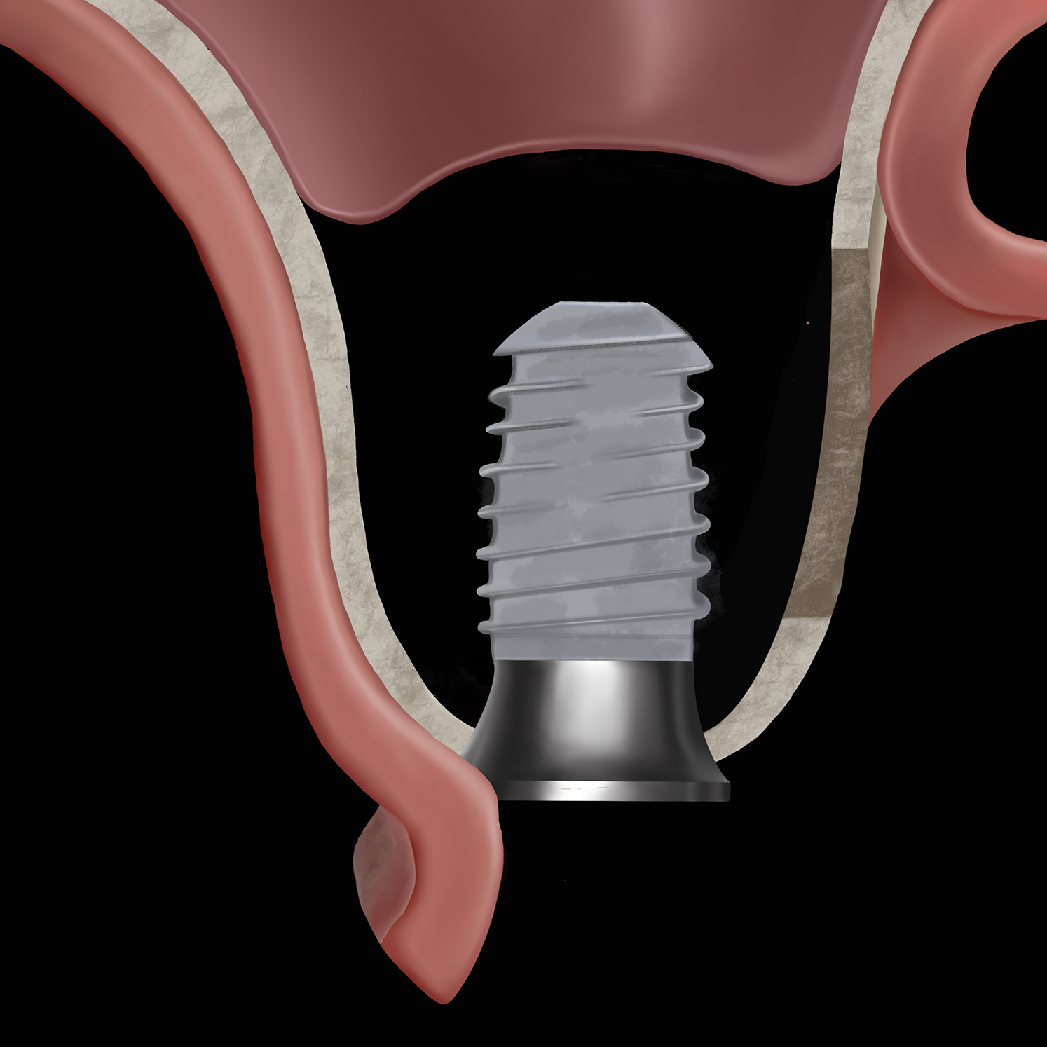 A clinical illustration of a dental implant with a sinus stabilizer abutment placed beneath the elevated Schneiderian membrane in the maxillary sinus.
