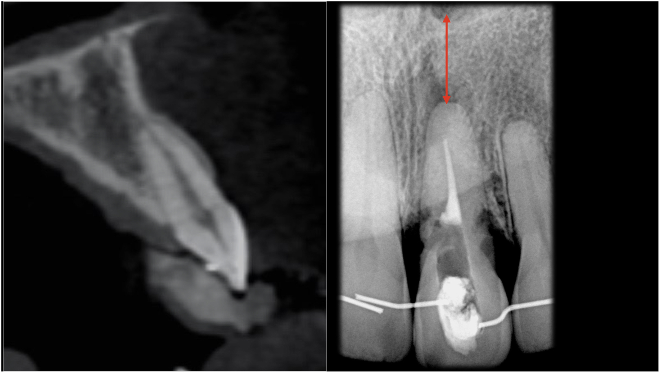 A set of two dental scans shows residual and apical bone. A radiograph on the right uses a vertical arrow to measure the bone above a tooth's root, important for immediate implant stability.