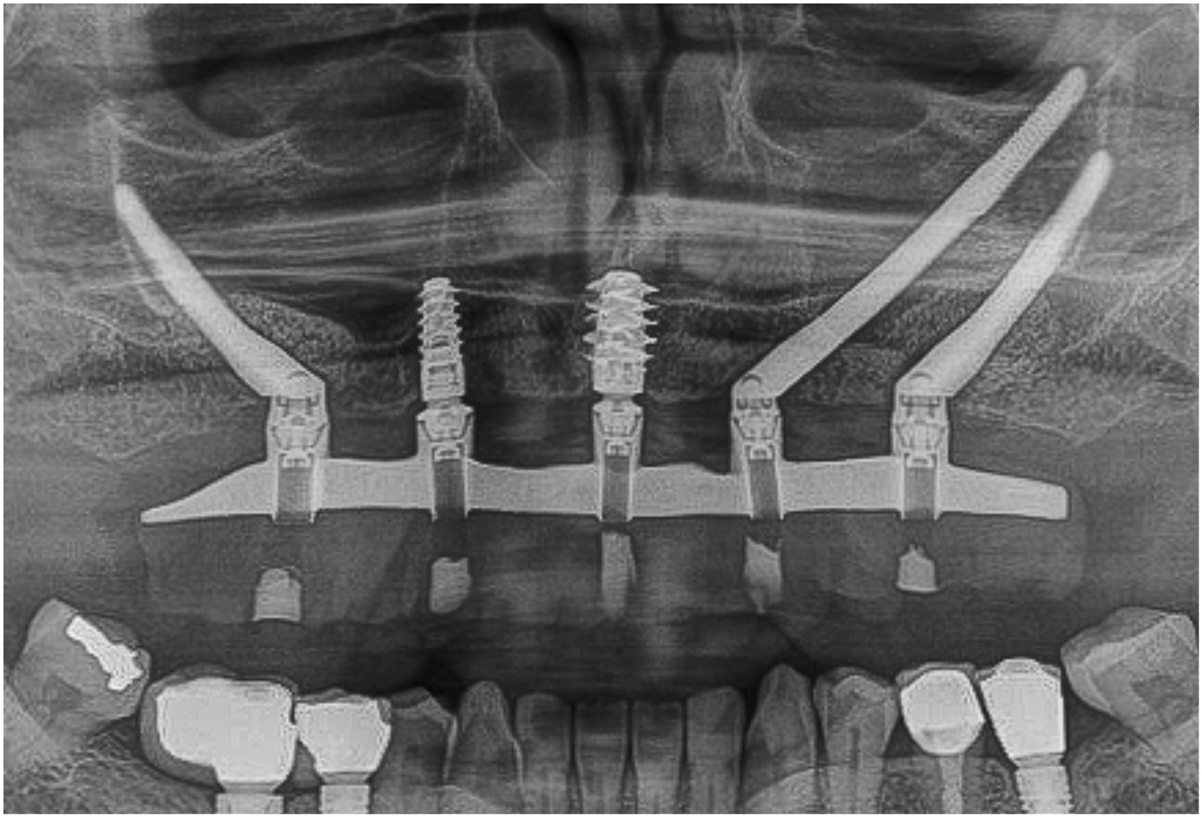 Wide jaw radiograph shows upper and lower teeth, multiple angled implants anchored into cheekbone regions, rigid bar connecting implant heads across upper arch, and prosthetic access alignment through implant heads.