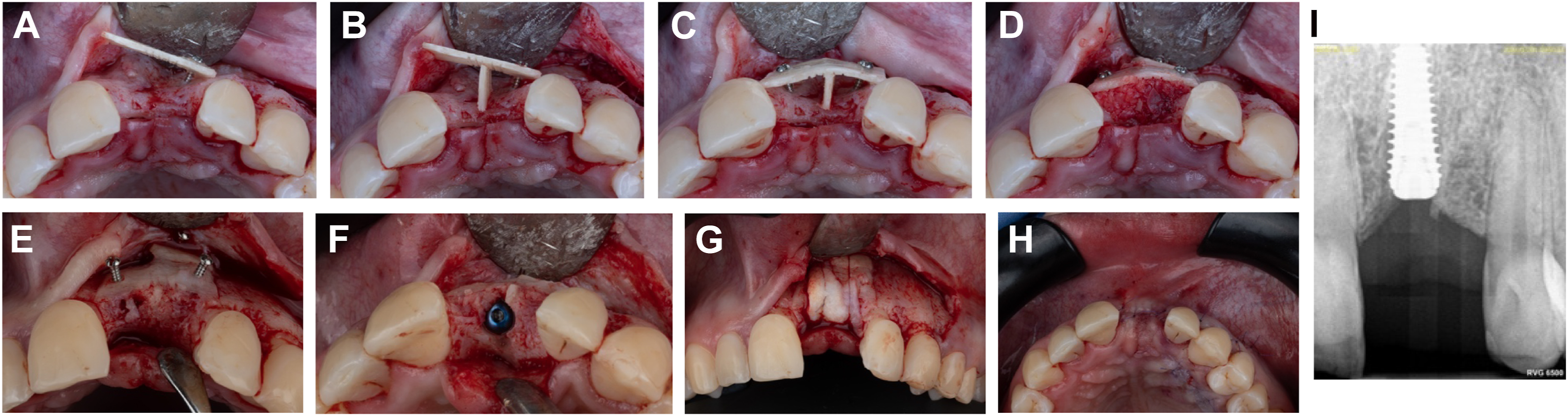 Nine dental photos show bone plate curvature using a bone wedge, grafting, implant placement after healing, soft tissue grafting, and periapical X-ray verifying final implant position.