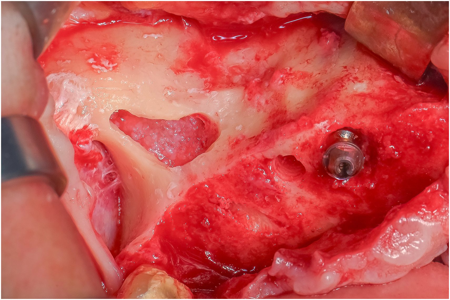 Intraoperative view shows exposed upper jaw bone with lateral opening, superior bone slot extending toward cheekbone region, and prepared implant trajectory defined by bone modification.