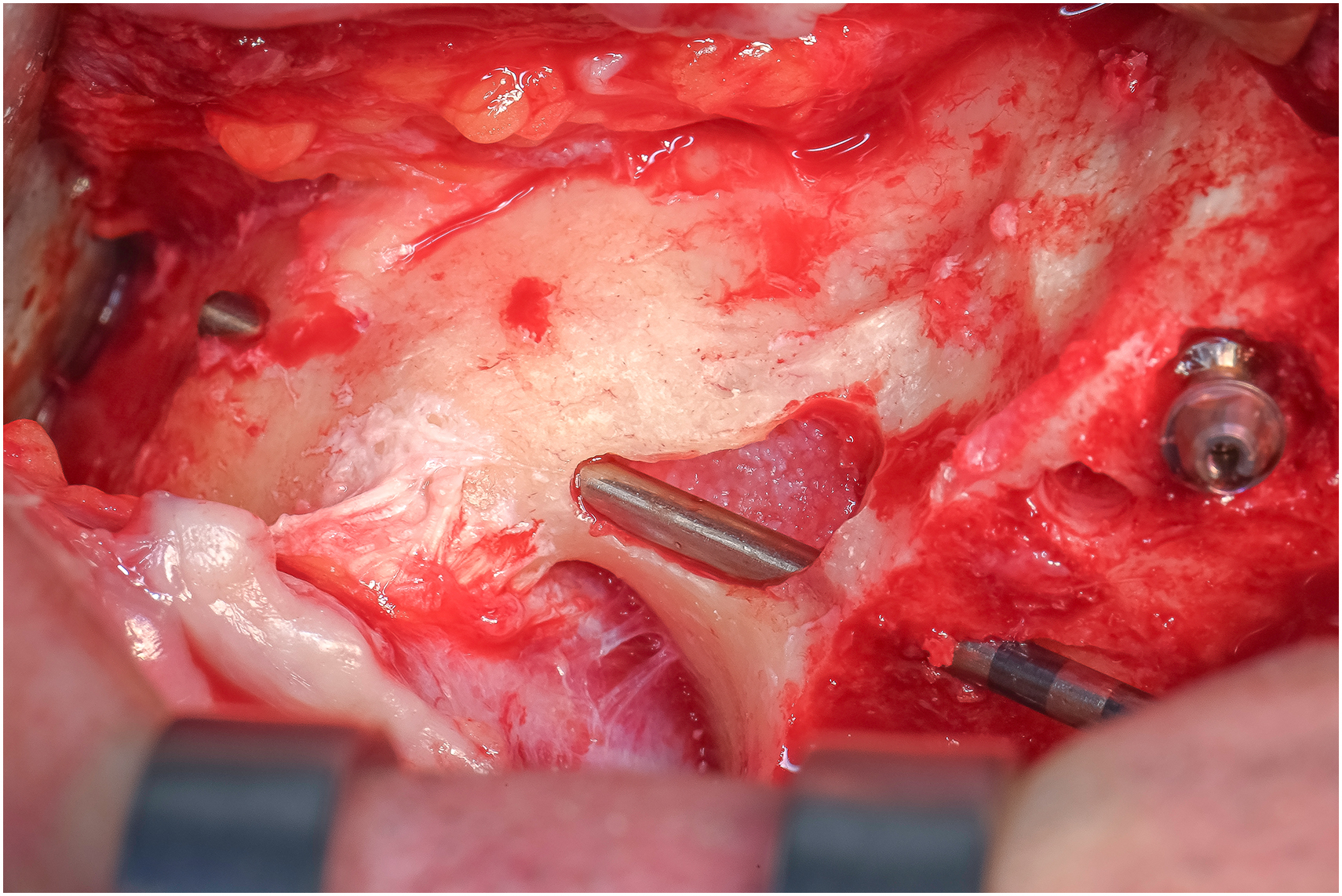 A photo shows a depth gauge with two tools outlining the implant trajectory in exposed tissue, with a screw visible.