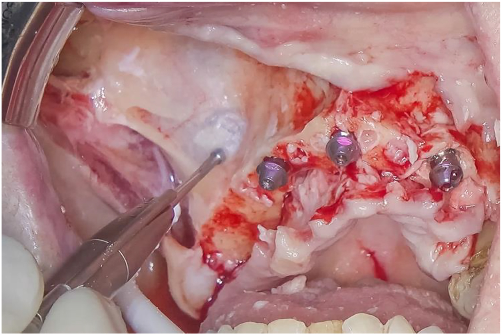 A photo shows a round drill with one tool outlining a Hockey Stick antrostomy, with three screws in exposed tissue.