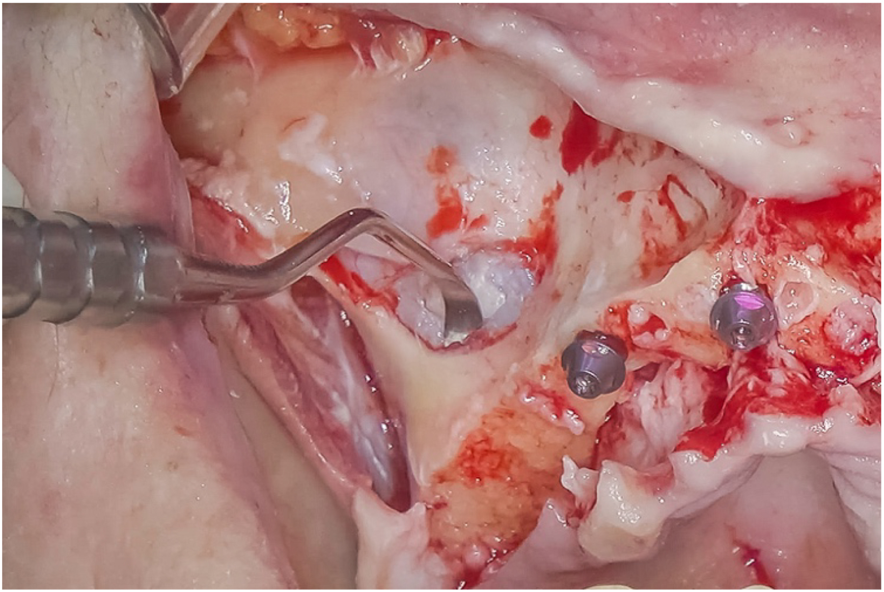 Intraoral surgical view shows curved sinus elevator lifting thin membrane from sinus floor, implant entry region exposed, adjacent bone margins visible, and controlled elevation around planned site.