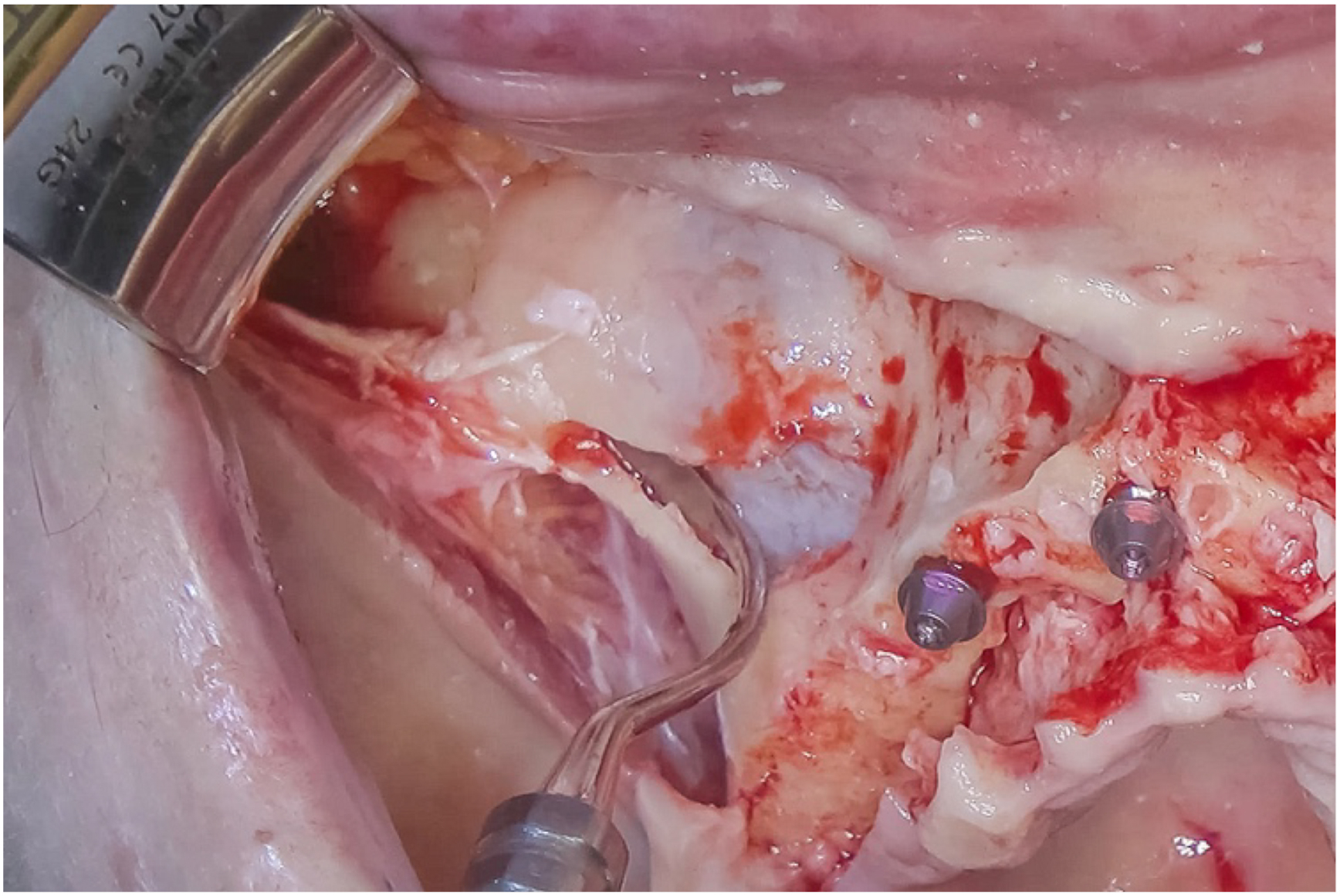 A photo shows an F I B I-1 Sinus membrane elevator with one tool and four screws in exposed tissue.