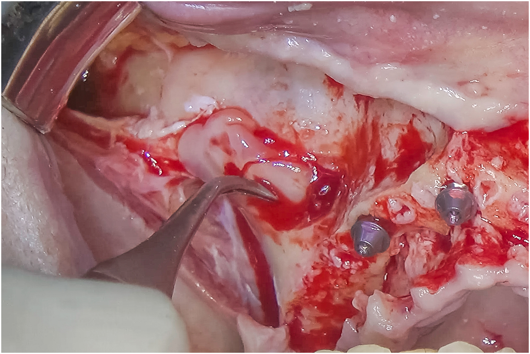 Surgical view shows sinus cavity interior with elevated membrane, intact lining along cavity wall, and created space positioned above upper jaw implant sites.