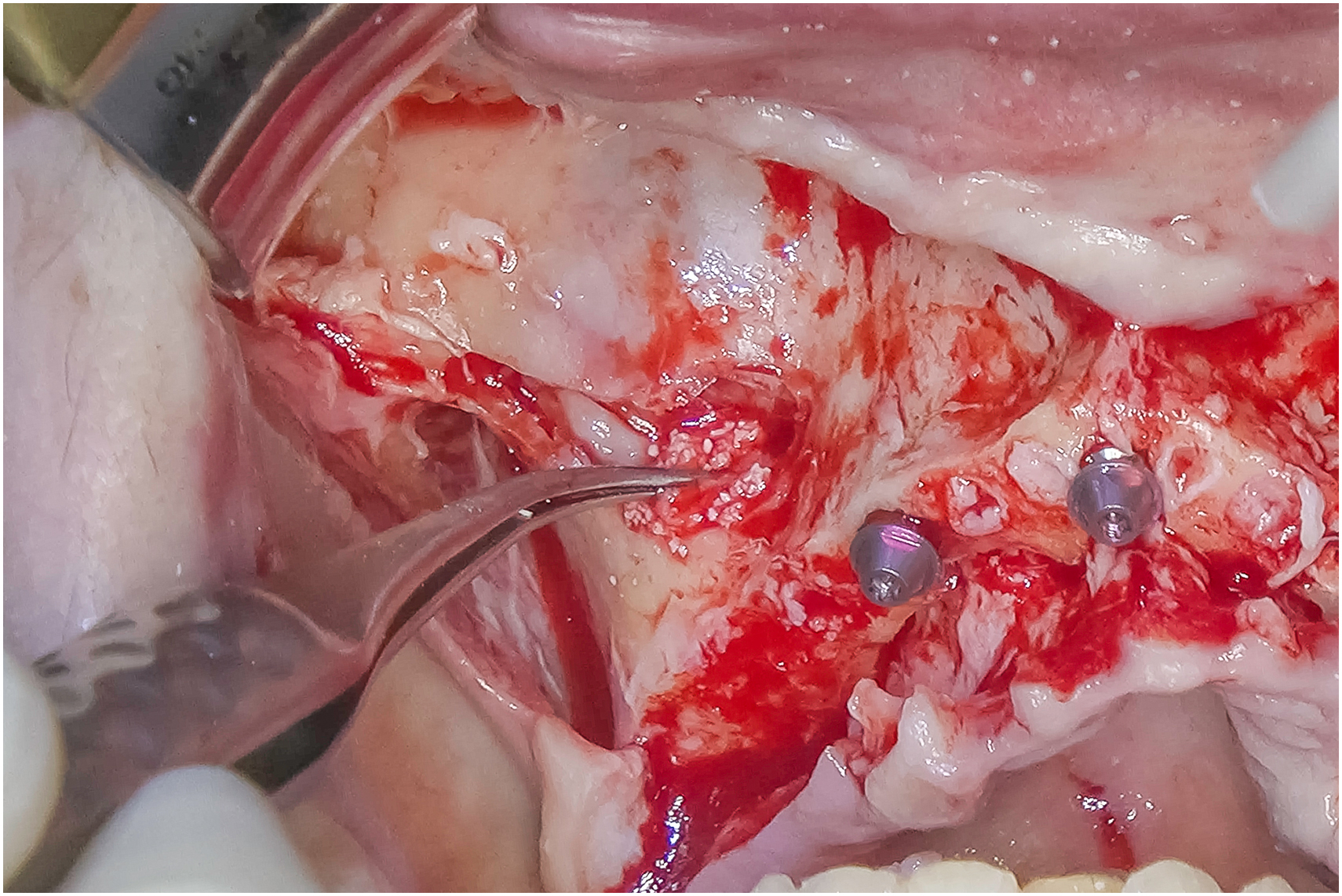Close surgical view shows layered graft material placed over elevated membrane, coverage of lateral bone opening, and graft adaptation surrounding implant fixtures.