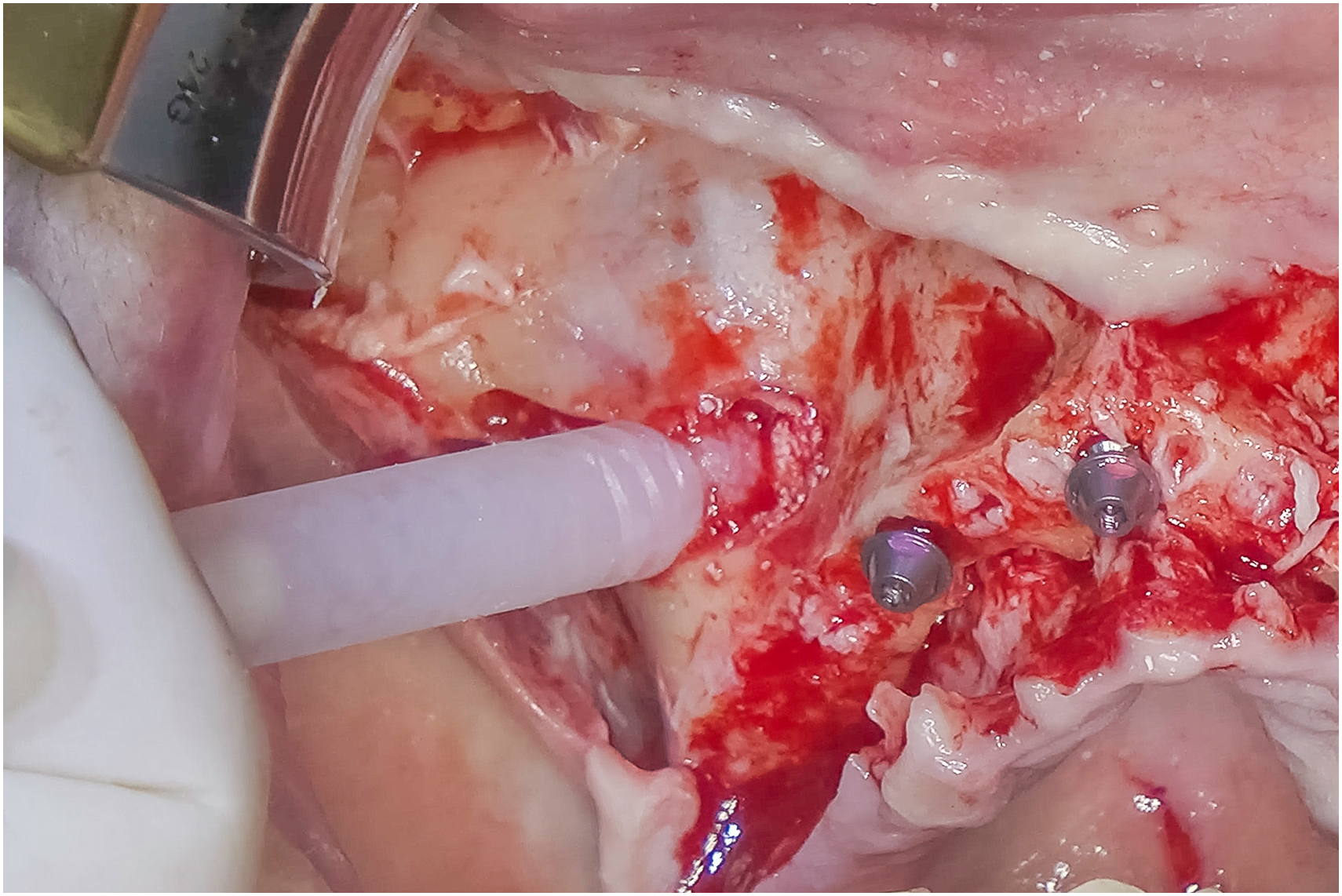 Intraoral surgical view shows particulate graft material delivered through applicator, graft placed onto prepared bone surface, exposed implant heads within site, and graft distributed around implant positions.