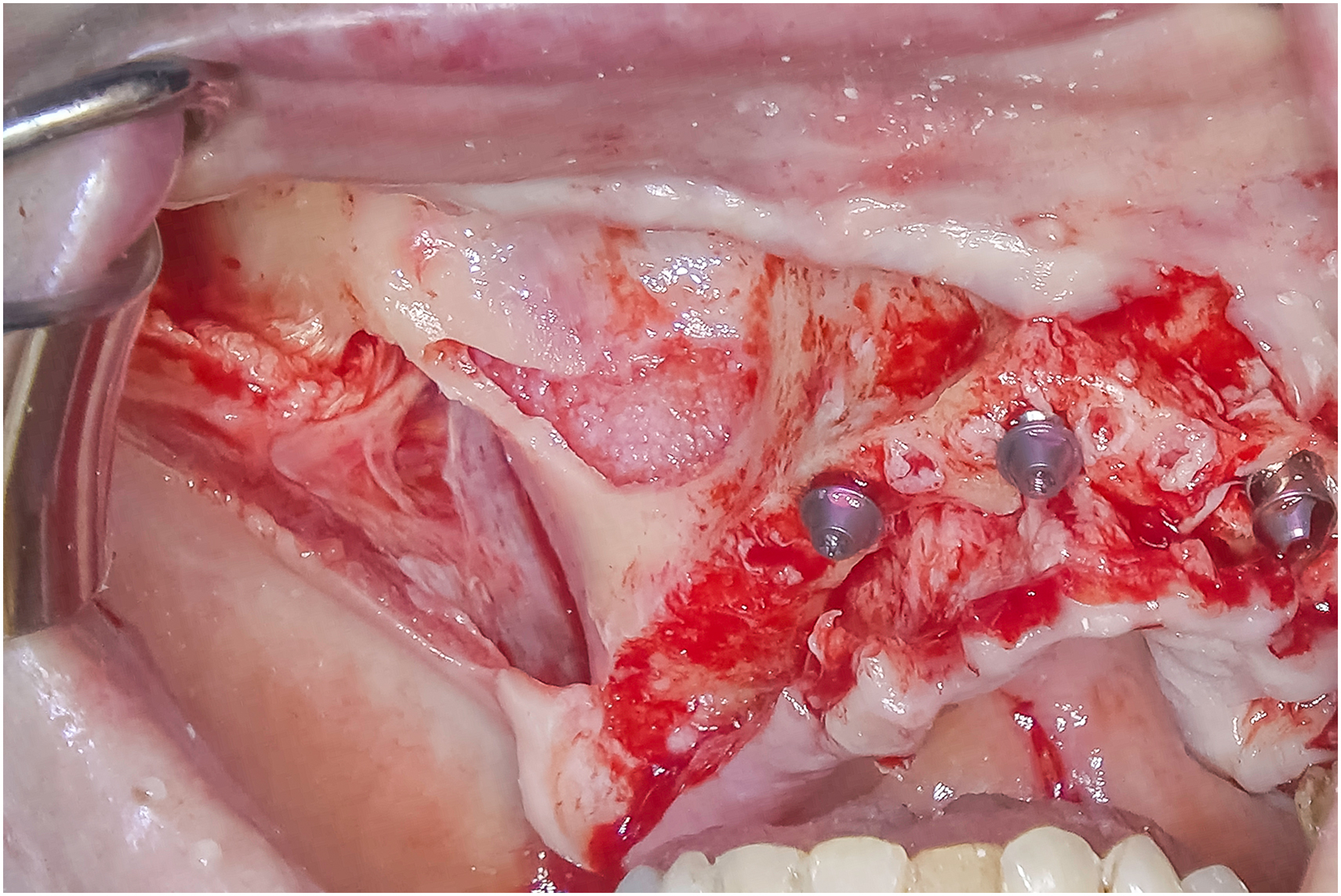 Intraoral surgical view shows particulate graft material compressed against underlying graft bed, implant heads exposed within prepared site, and graft surface contoured to support drilling trajectory.