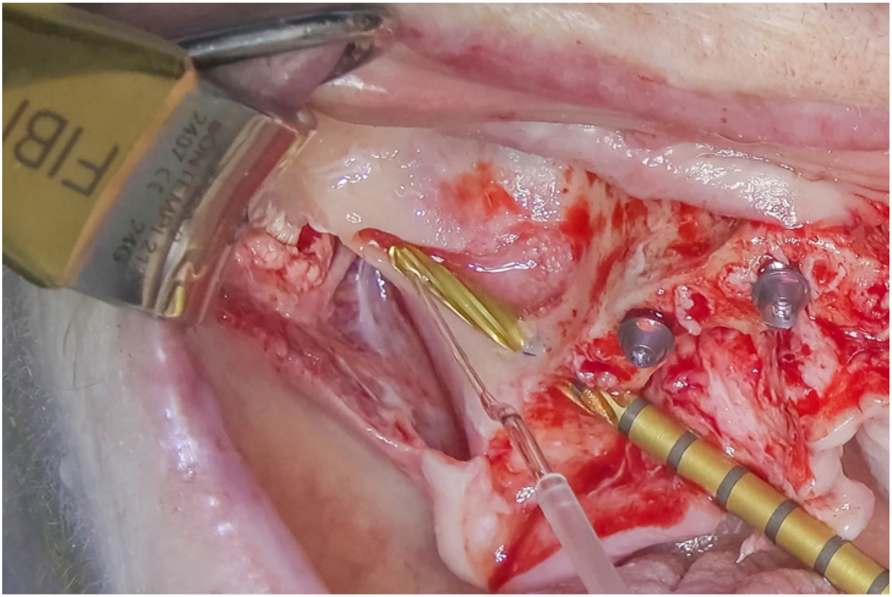 A photo shows NanoBone with two tools and two screws protecting BioOss and sinus mucosa in exposed tissue.