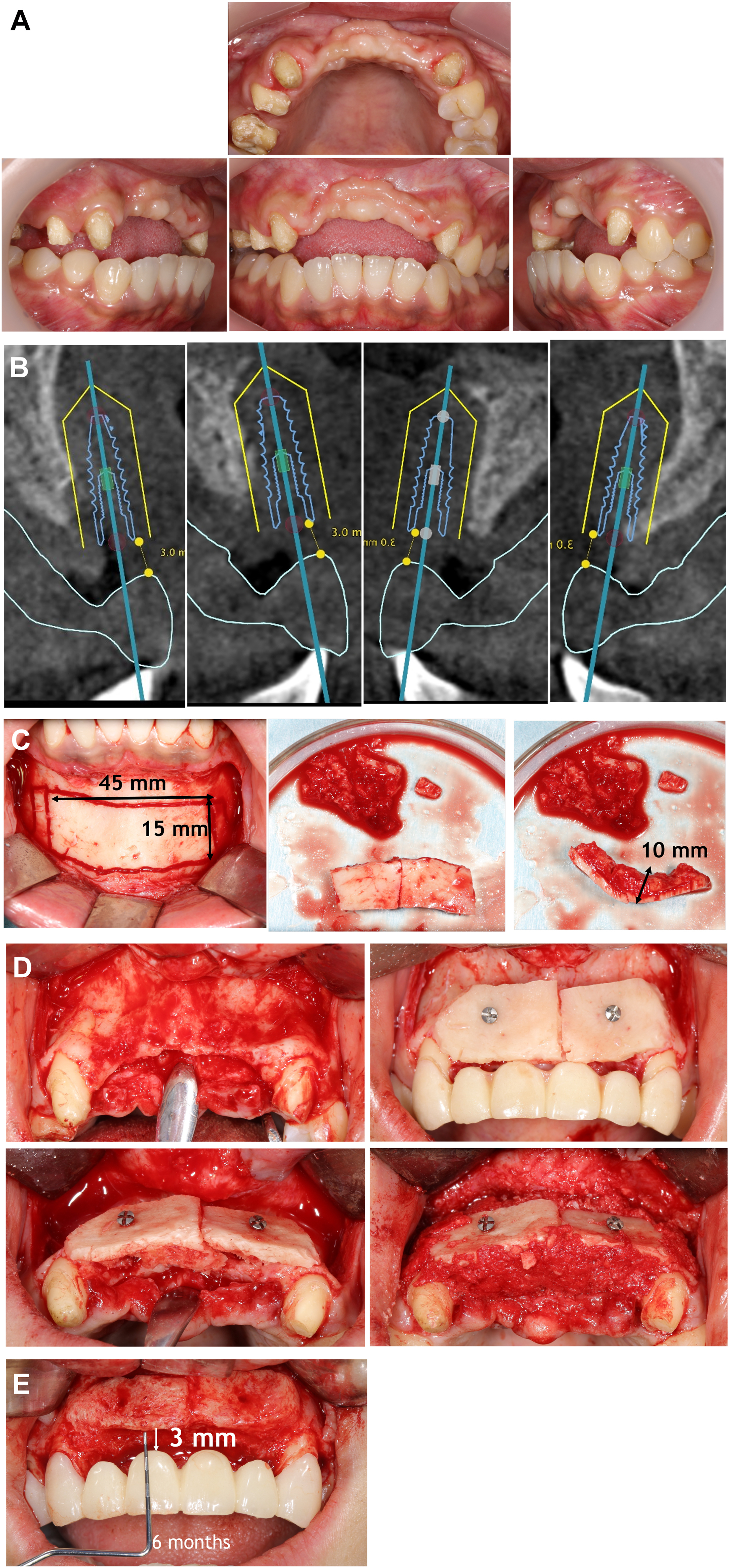 A multi-panel dental case shows the reconstruction of four missing front teeth using a bone block graft from the jaw, followed by implant placement and final aesthetic restoration.