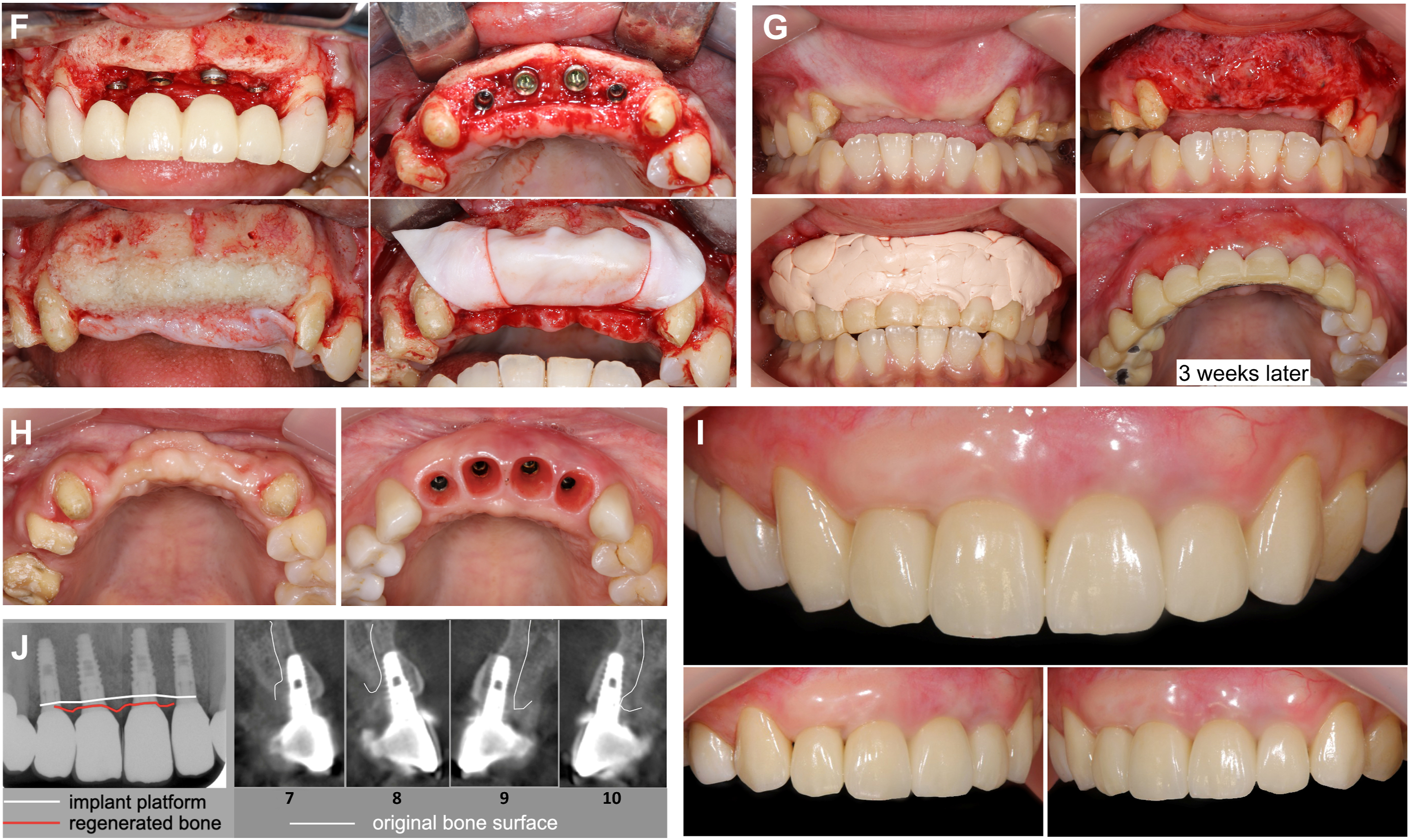 A multi-panel dental case shows the reconstruction of four missing front teeth using a bone block graft from the jaw, followed by implant placement and final aesthetic restoration.