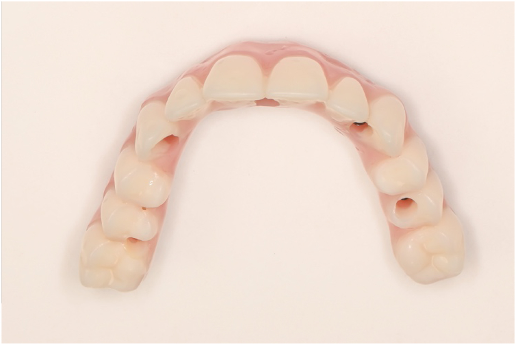 A photo of a dental prosthesis with multiple teeth and two implant sites from left to right.