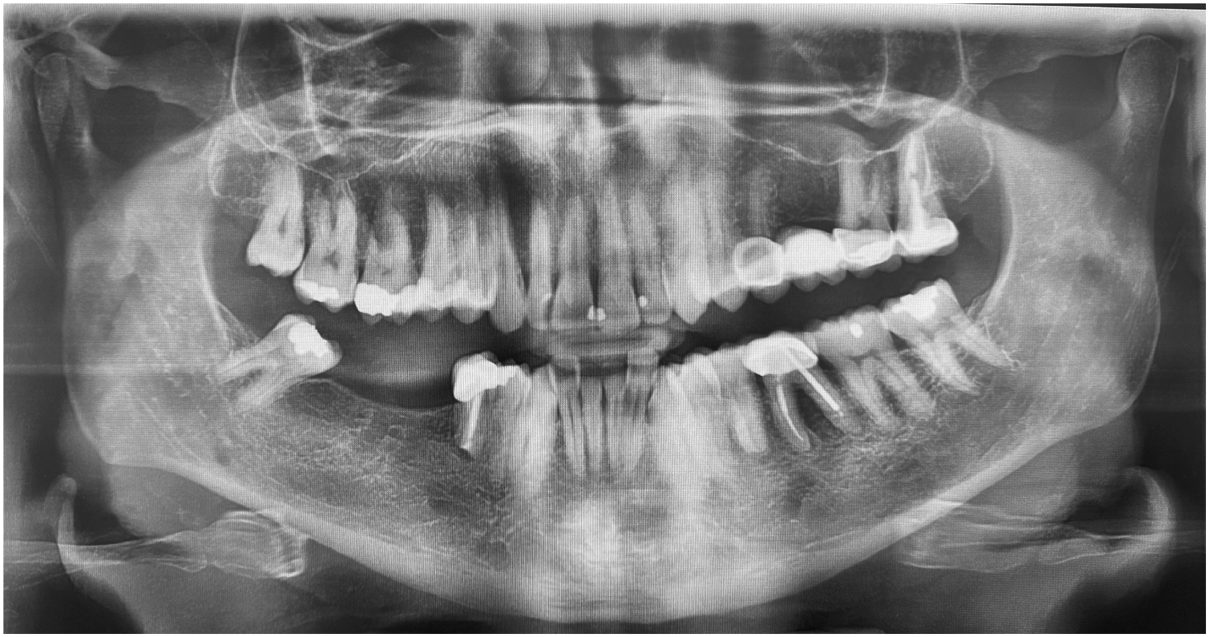 A panoramic scan of the mandible and maxilla with full dentition, multiple restorations, an impacted third molar on the lower right, and a mesh structure in the anterior mandibular region.