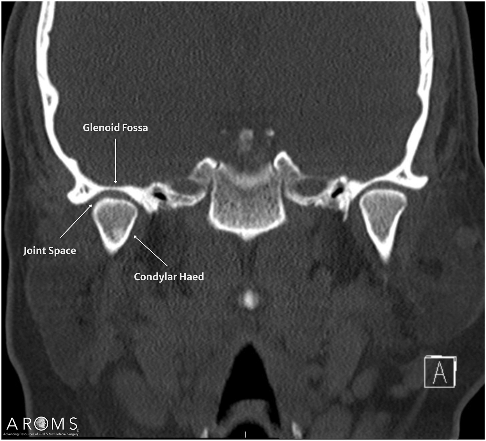 Alt text begins. An X-ray of the temporomandibular joint in coronal view with labeled glenoid fossa, joint space, and condylar head on both sides. Alt text provided by Elsevier.