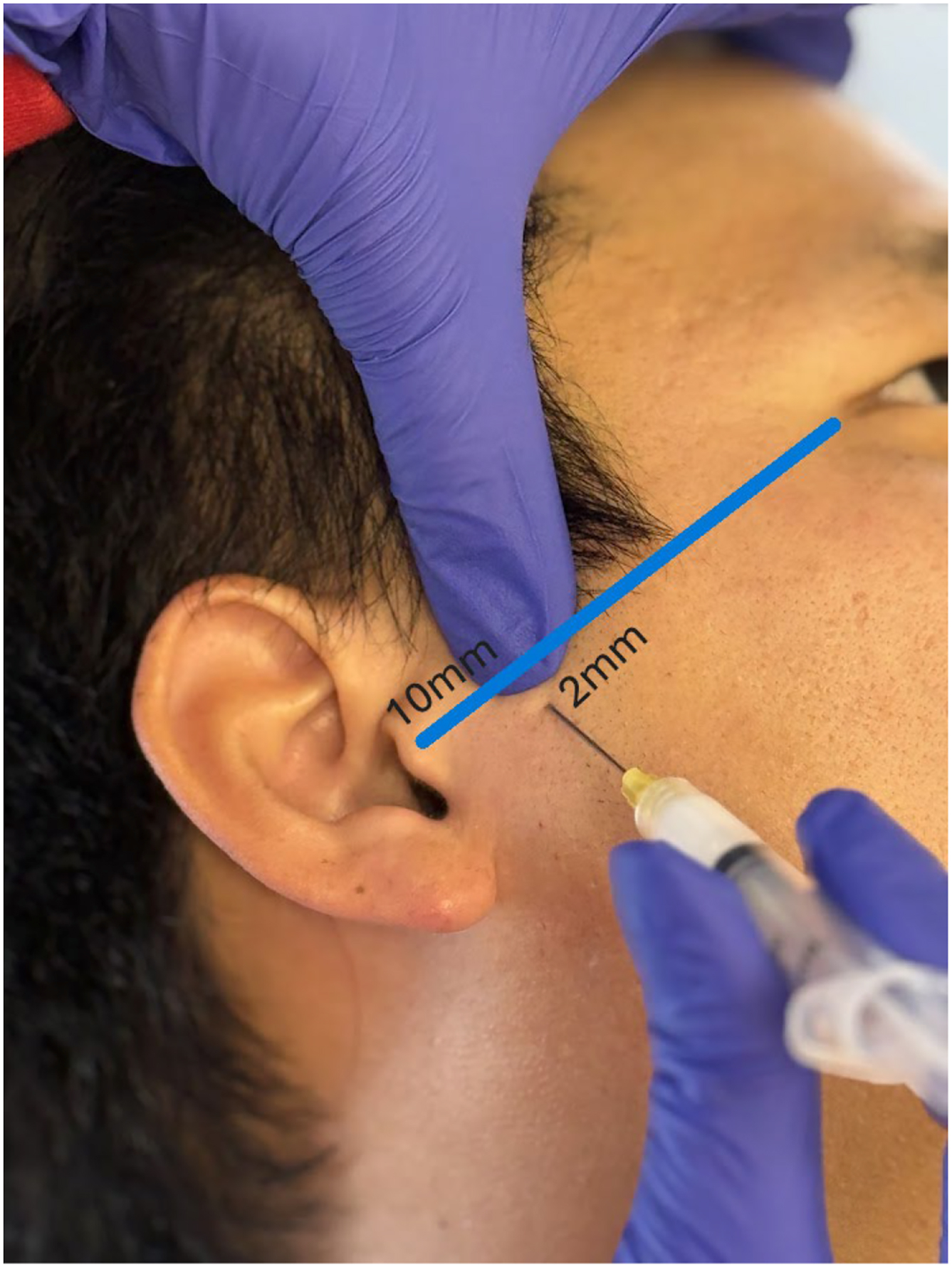 Alt text begins. A photograph depicts gloved hands performing posterior insertion near the ear with a syringe positioned below a line extending from the lateral eye region to the ear and labeled 10 and 2 millimeters. Alt text provided by Elsevier.
