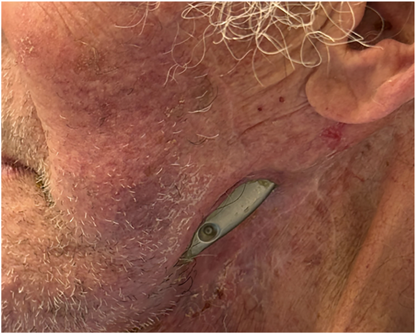Alt text begins. A close-up of a patient's left preauricular area shows an exposed metallic temporomandibular joint total joint replacement implant protruding through unhealed irradiated skin. Alt text provided by Elsevier.