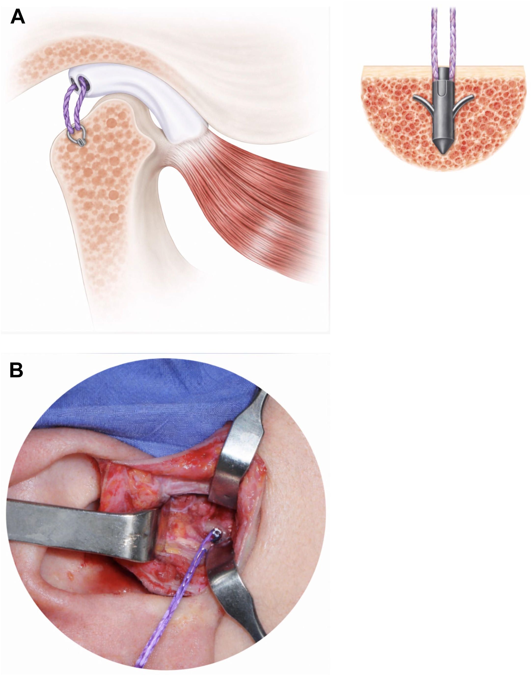 Alt text begins. A two-panel view shows open discopexy displaying a schematic of posterior superior disc repositioning using an anchor and the intraoperative view. Alt text provided by Elsevier.