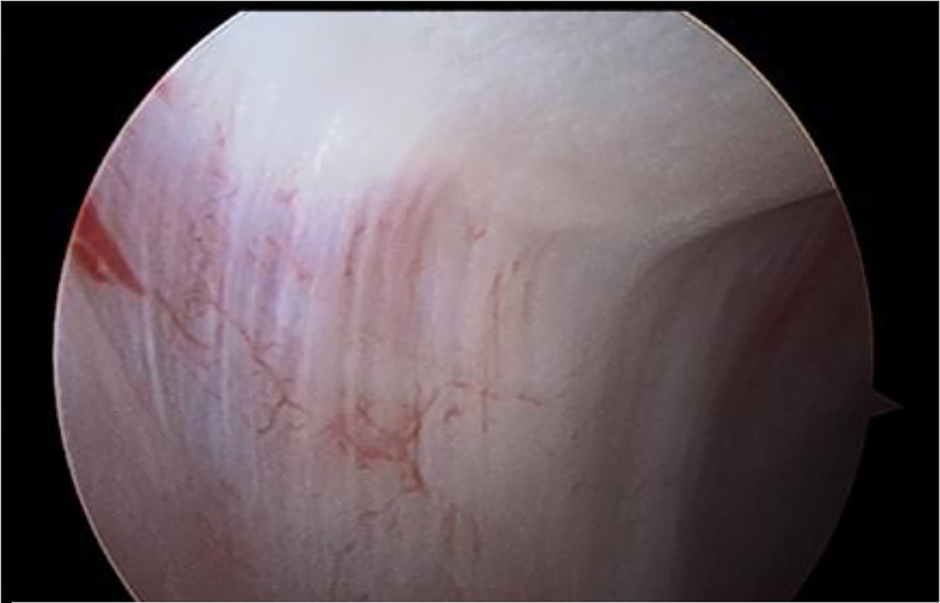 Alt text begins. An arthroscopic view shows the medial synovial drape as pale, folded tissue with fine reddish vascular markings. Alt text provided by Elsevier.