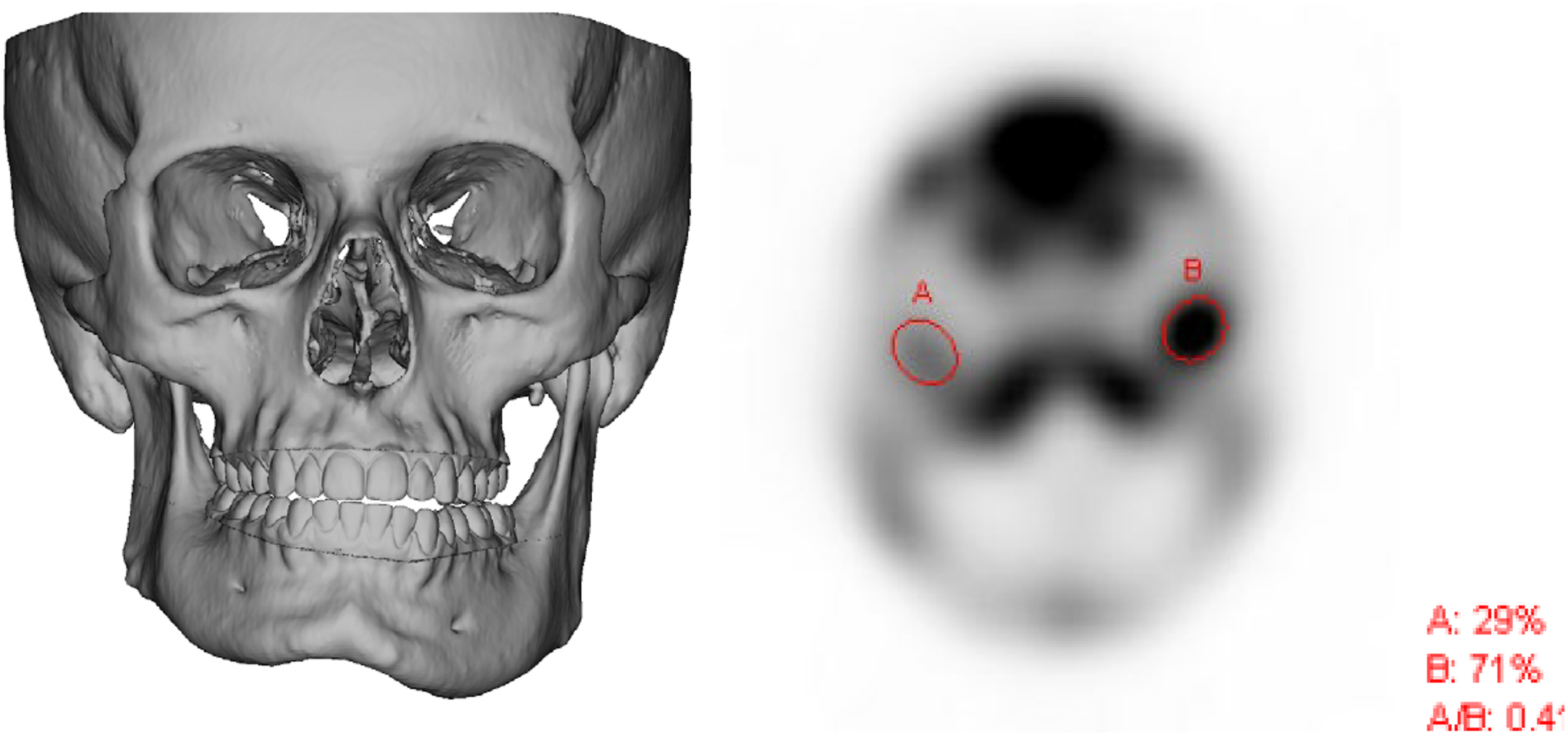 Alt text begins. A computed tomography reconstruction and single photon emission computed tomography show mandibular asymmetry, left posterior open bite, and left condylar uptake. Alt text provided by Elsevier.