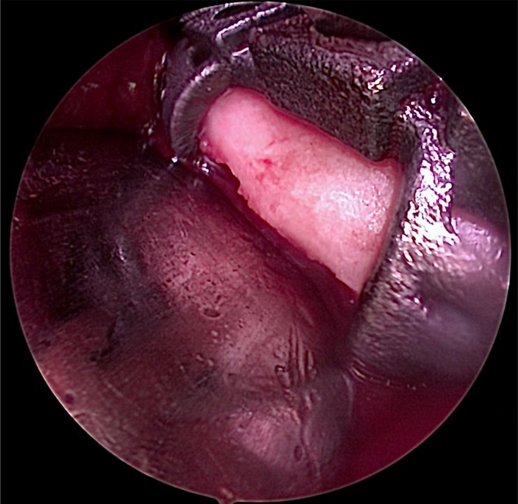 Alt text begins. An endoscopic intraoperative view shows the adaptation of the condylar cutting guide along the right mandibular angle. Alt text provided by Elsevier.