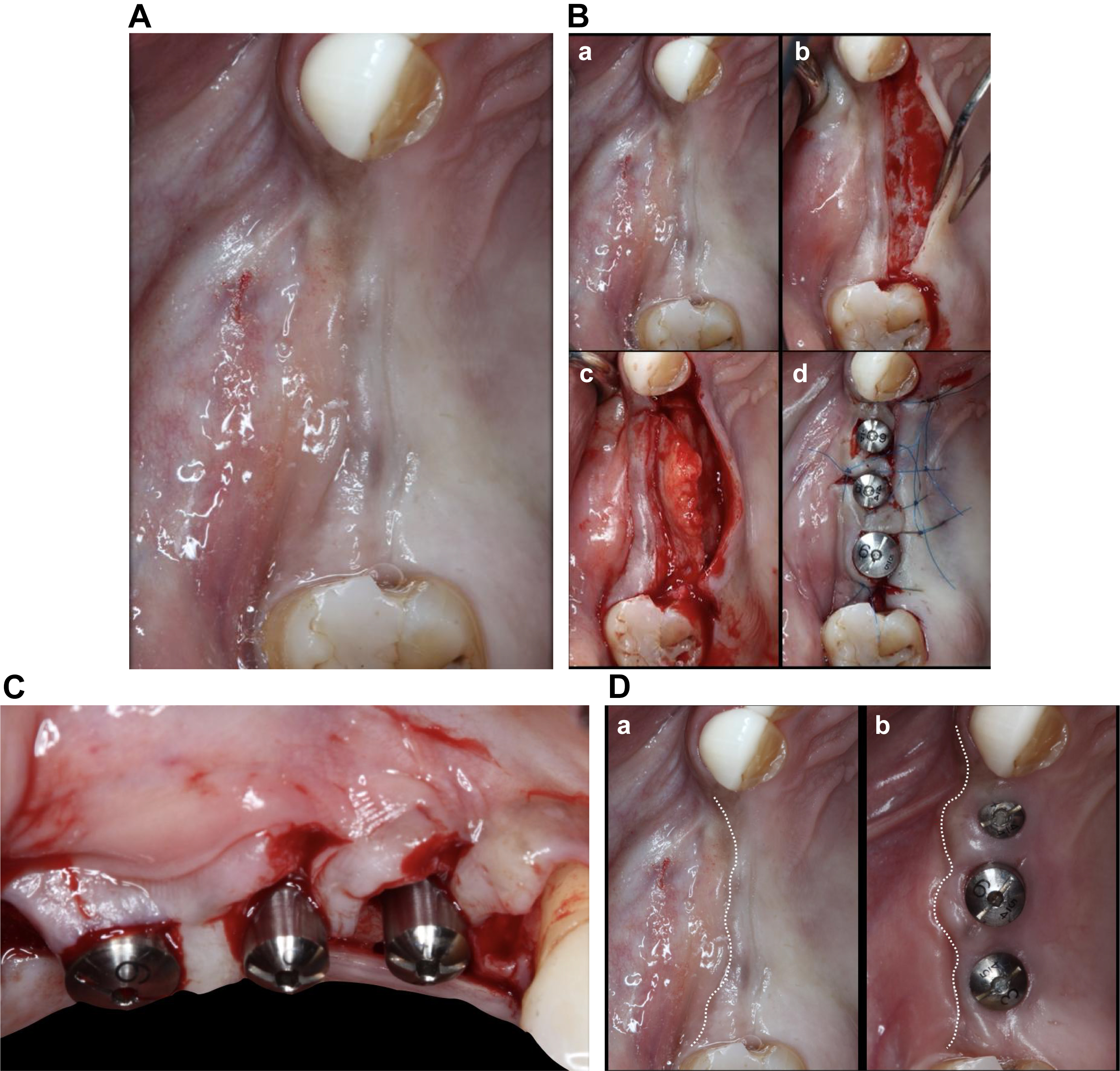 A multi-panel clinical photo shows soft tissue augmentation around posterior maxillary implants using a palatal pedicled connective tissue graft and phenotype modification techniques.