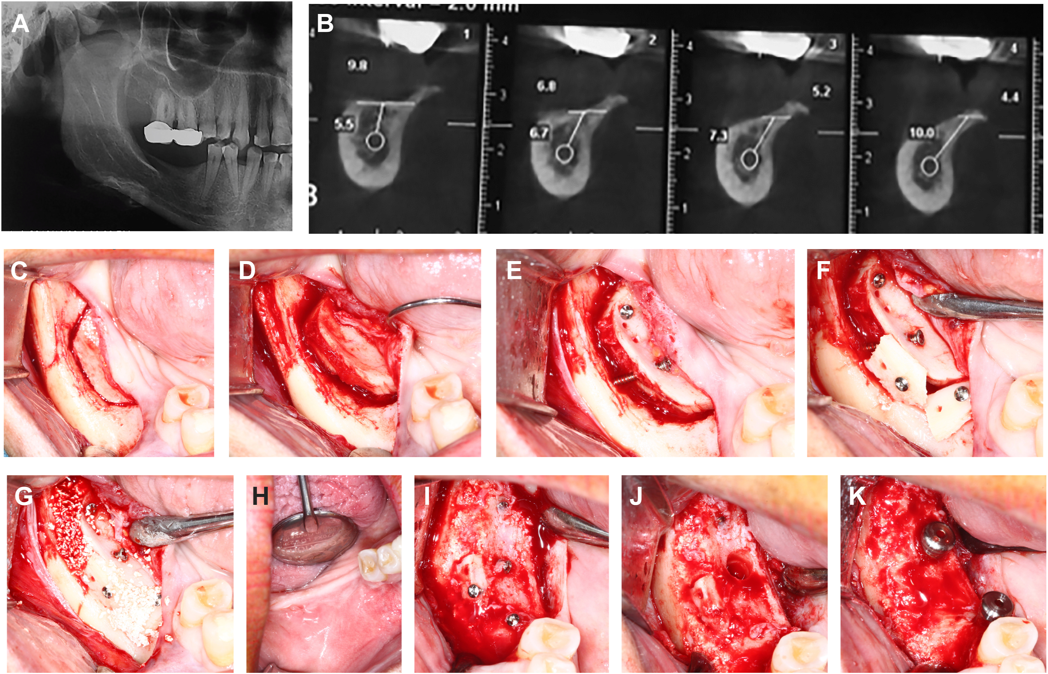 A set of eleven panels labeled A to K shows mandibular reconstruction with radiographs, bone section measurements, and sequential intraoral fixation and grafting steps.