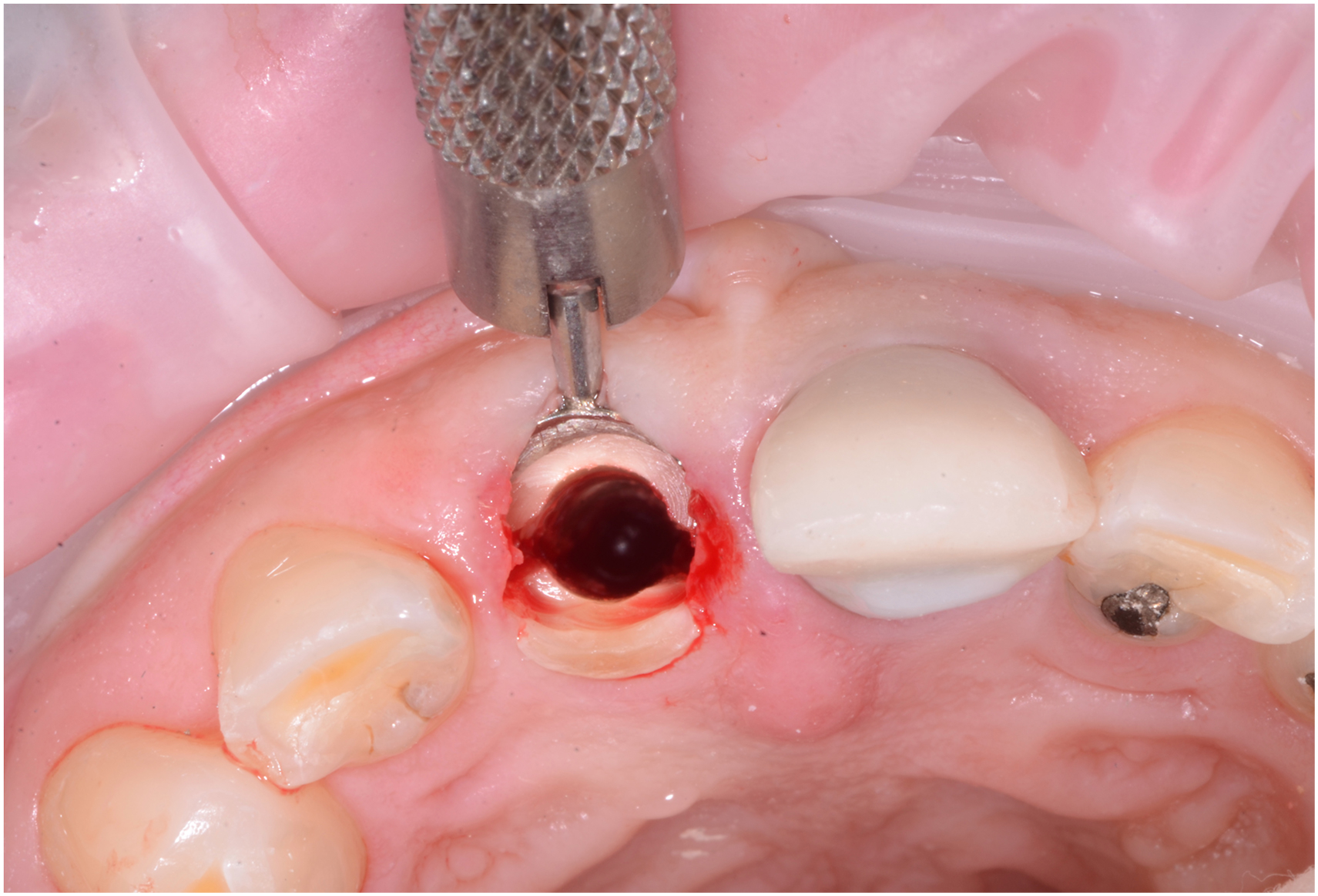 An occlusal view of an upper front tooth during a dental procedure where a dental drill works on a sectioned root surface with surrounding gingival tissue and slight bleeding near the treated area.